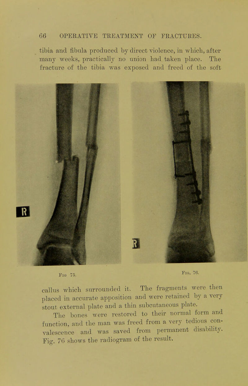 tibia and fibula produced by direct violence, in which, after many weeks, practically no union had taken place. The fracture of the tibia was exposed and freed of the soft callus which surrounded it. The fragments were then placed in accurate apposition and were retained by a very stout external plate and a thin subcutaneous plate. The bones were restored to their normal form and function, and the man was freed from a very tedious con- valescence and was saved from permanent disability. Fig. 70 shows the radiogram of the result.