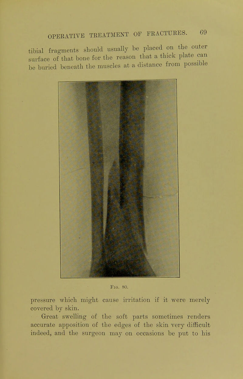 tibial fragments should usually be placed on the outer surface of that bone for the reason that a thick plate can be buried beneath the muscles at a distance from possible Fig. 80. pressure which might cause irritation if it were merely covered by skin. Great swelling of the soft parts sometimes renders accurate apposition of the edges of the skin very difficult indeed, and the surgeon may on occasions be put to his