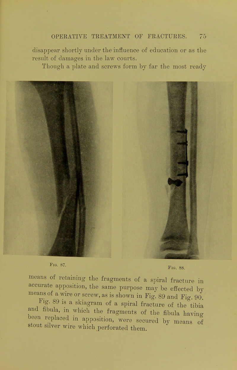 disappear shortly under the influence of education or as the result of damages in the law courts. Though a plate and screws form by far the most ready I FlG- 87- Fid. 88. means of retaining the fragments of a spiral fracture in accurate apposition, the same purpose may be effected by means of a wire or screw, as is shown in Fig. 89 and Fio-. 90 Fig 89 is a skiagram of a spiral fracture of the&tibia and fibula, m which the fragments of the fibula having been replaced in apposition, were secured by means of stout silver wire which perforated them.