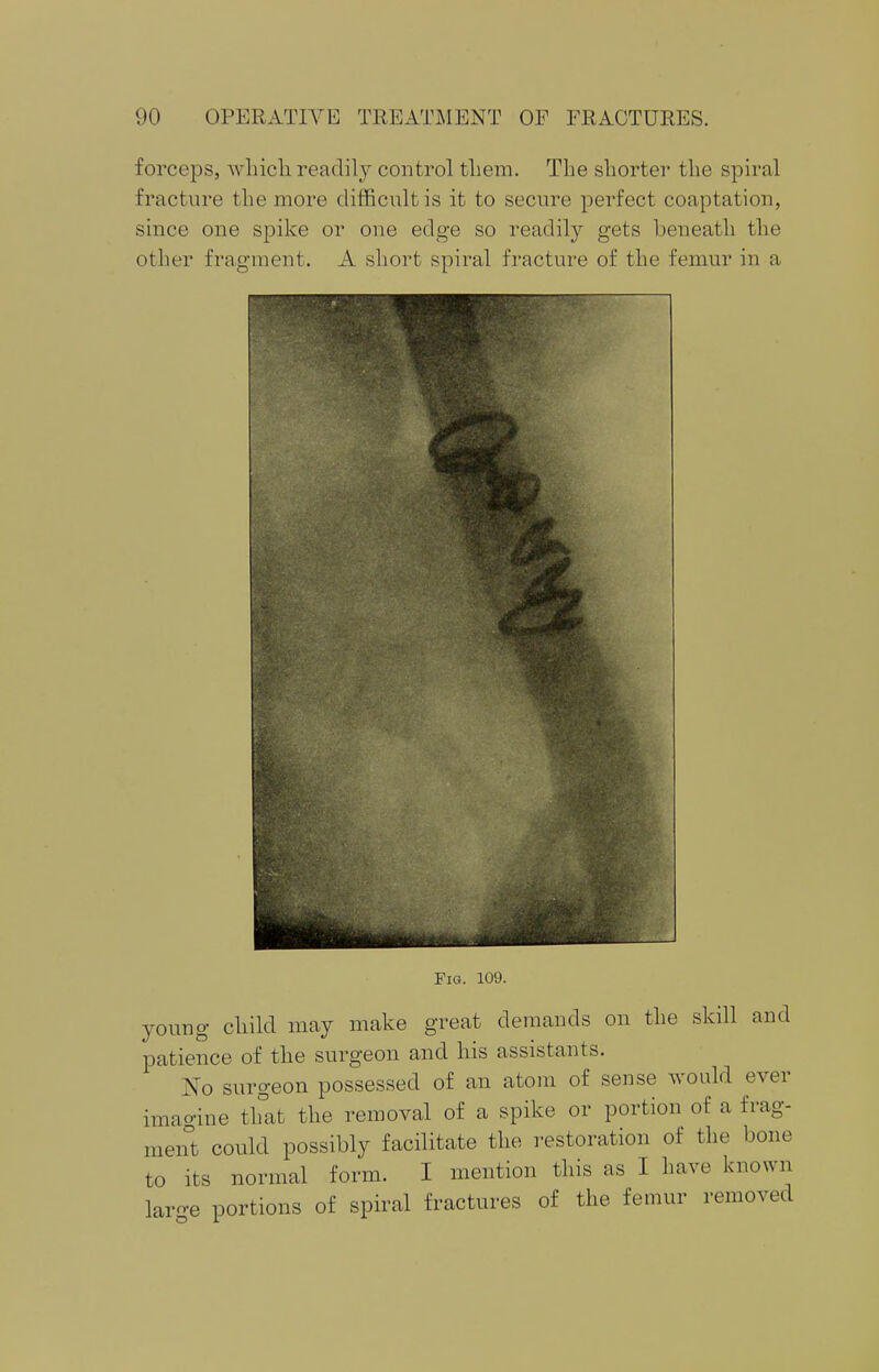 forceps, which, readily control them. The shorter the spiral fracture the more difficult is it to secure perfect coaptation, since one spike or one edge so readily gets beneath the other fragment. A short spiral fracture of the femur in a Fig. 109. young child may make great demands on the skill and patience of the surgeon and his assistants. No surgeon possessed of an atom of sense would ever imagine that the removal of a spike or portion of a frag- ment could possibly facilitate the restoration of the bone to its normal form. I mention this as I have known laro-e portions of spiral fractures of the femur removed