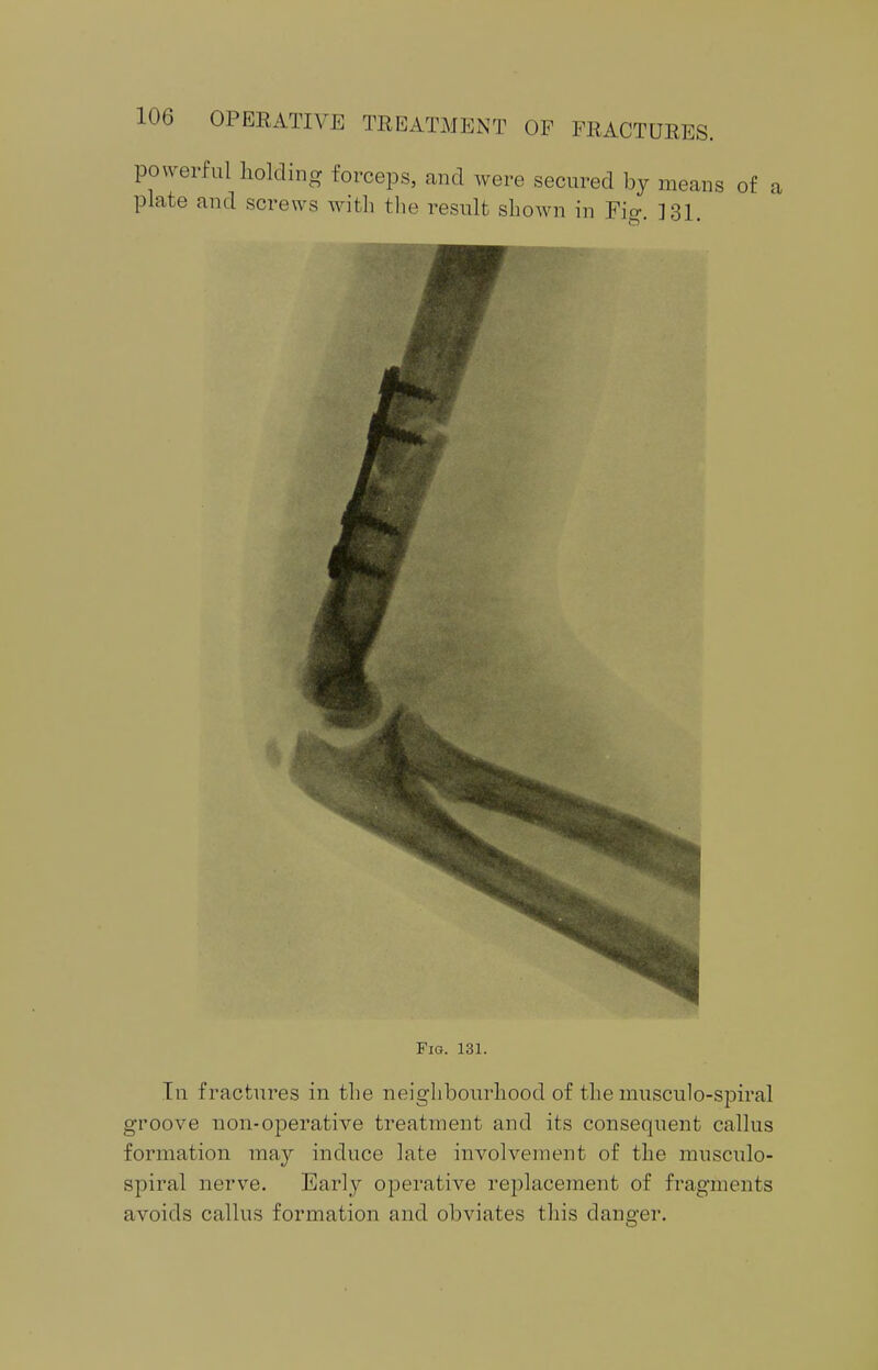 powerful holding forceps, and were secured by means of plate and screws with the result shown in Fig. 131. a Fig. 131. In fractures in the neighbourhood of the musculo-spiral groove non-operative treatment and its consequent callus formation may induce late involvement of the musculo- spiral nerve. Early operative replacement of fragments avoids callus formation and obviates this danger.