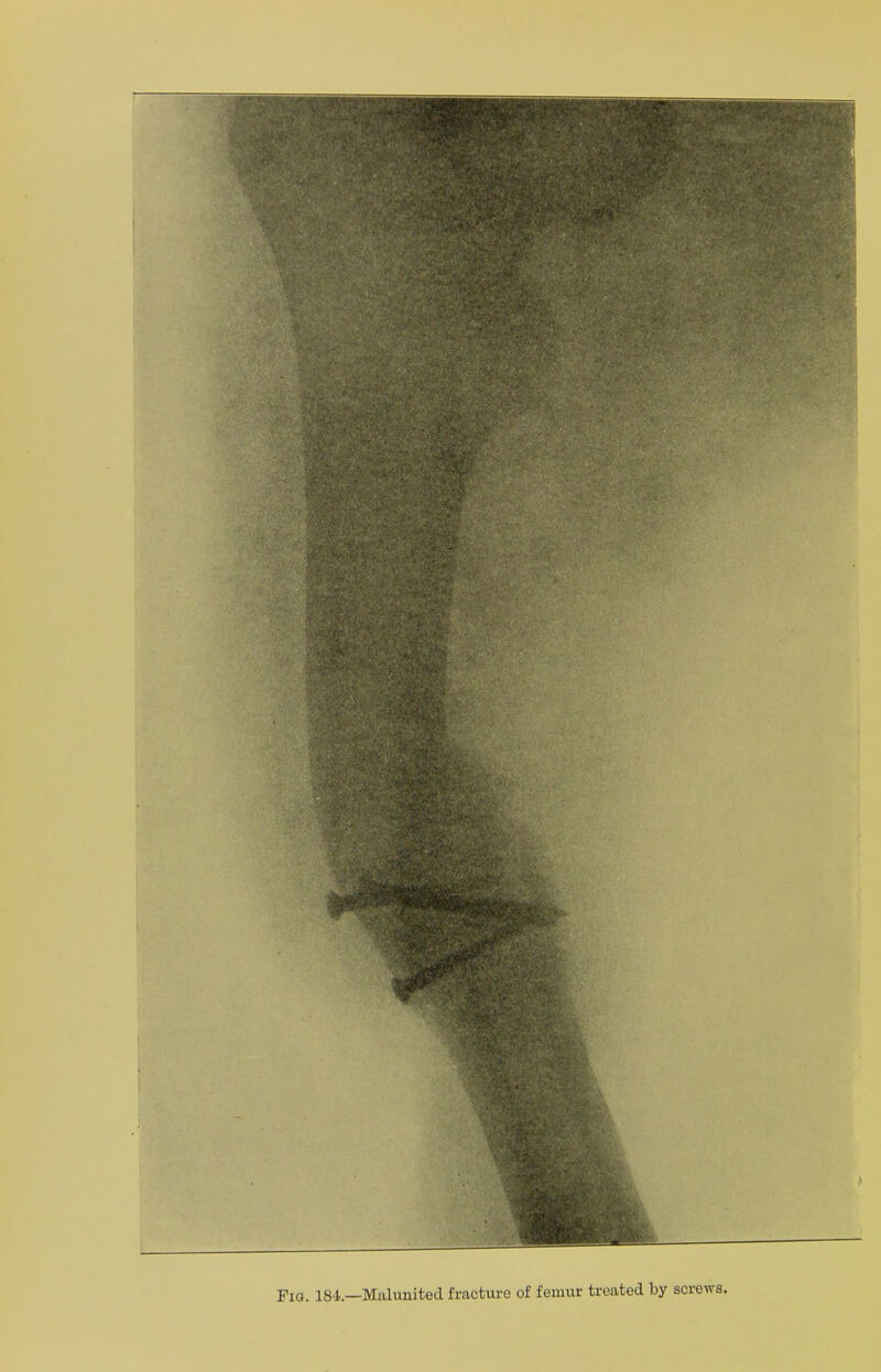 Fig. 18-4.—Malunited fracture of femur treated by screws.