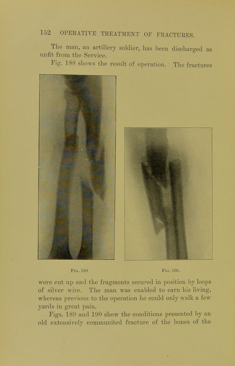 The man, an artillery soldier, has been discharged as unfit from the Service. Fig. 188 shows the result of operation. The fractures Fig. 189. Fin. 190. were cut up and the fragments secured in position by loops of silver wire. The man was enabled to earn his living, whereas previous to the operation he could only walk a few yards in great pain. Figs. 189 and 190 show the conditions presented by an old extensively communited fracture of the bones of the