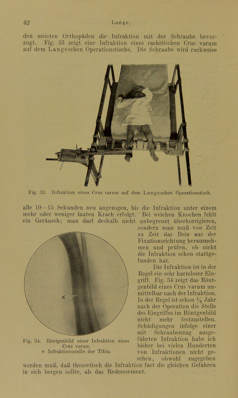 den meisten Orthopäden die ini'raktion mit der Schraube bevor- zugt. Fig. 33 zeigt eine Infraktion eines rachitisclien Crus varum auf dem Langeschen Operationstische. Die Schraube wird ruclcweise / Fig. 33. Infraktion eines Crus varum auf dem Langeschen Operationstisch. alle 10—15 Sekunden neu angezogen, bis die Infraktion unter einem mehr oder weniger lauten Krach erfolgt. Bei weichen Knochen fehlt ein Geräusch; man darf deshalb nicht unbegrenzt überkorrigieren, sondern man muß von Zeit zu Zeit das Bein aus der Fixationsrichtung herausneh- men und prüfen, ob nicht die Infraktion schon stattge- funden hat. Die Infraktion ist in der Regel ein sehr harmloser Ein- griff. Fig. 34 zeigt das Rönt- genbild eines Crus varum un- mittelbar nach der Infraktion. In der Regel ist schon Jahr nach der Operation die Stelle des Eingriffes im Röntgenbild nicht mehr festzustellen. Schädigungen infolge einer mit Schrauben zug ausge- führten Infraktion habe ich bisher bei vielen Hunderten von Infraktionen nicht ge- sehen, obwohl zugegeben werden muß, daß theoretisch die Infraktion fast die gleichen Gefahren in sich bergen sollte, als das Rcdressement. Fig. 34. Röntgenbild einer Infraktion eines Crus varum. X Infraktionsstelle der Tibia.