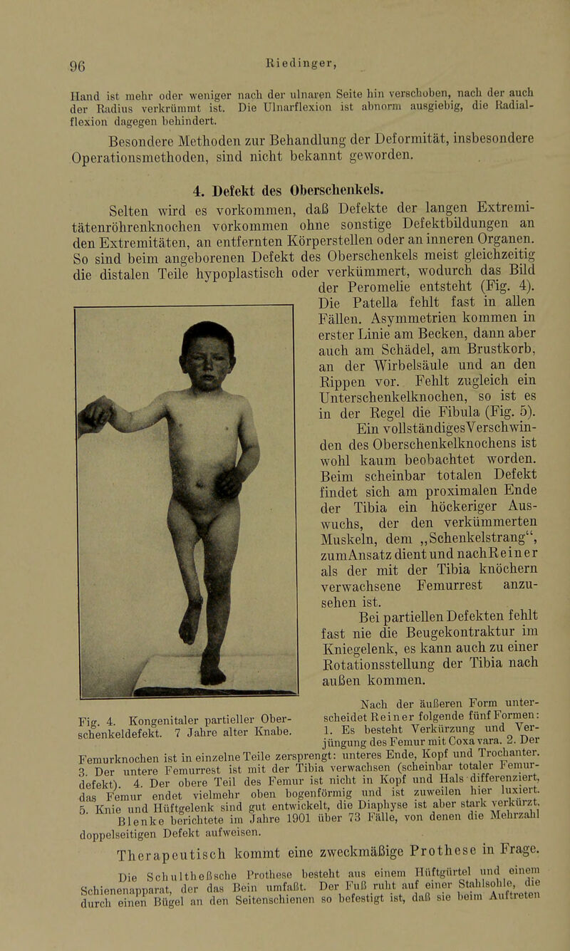 Hand ist mehr oder weniger nacli der ulnaren Seite hin verschoben, nach der auch der Radius verkrümmt ist. Die Ulnarflexion ist abnorm ausgiebig, die Radial- flexion dagegen behindert. Besondere Methoden zur Behandlung der Deformität, insbesondere Operationsmethoden, sind nicht bekannt geworden. 4. Defekt des Oberschenkels. Selten wird es vorkommen, daß Defekte der langen Extremi- tätenröhrenknochen vorkommen ohne sonstige Defektbildungen an den Extremitäten, an entfernten Körperstellen oder an inneren Organen. So sind beim angeborenen Defekt des Oberschenkels meist gleichzeitig die distalen Teile hypoplastisch oder verkümmert, wodurch das Bild der Peromelie entsteht (Fig. 4). Die Patella fehlt fast in allen Fällen. Asymmetrien kommen in erster Linie am Becken, dann aber auch am Schädel, am Brustkorb, an der Wirbelsäule und an den Kippen vor. Fehlt zugleich ein Unterschenkelknochen, so ist es in der Regel die Fibula (Fig. b). Ein voUständigesVerschwin- den des Oberschenkelknochens ist wohl kaum beobachtet worden. Beim scheinbar totalen Defekt findet sich am proximalen Ende der Tibia ein höckeriger Aus- wuchs, der den verkümmerten Muskeln, dem „Schenkelstrang, zum Ansatz dient und nachReiner als der mit der Tibia knöchern verwachsene Femurrest anzu- sehen ist. Bei partiellen Defekten fehlt fast nie die Beugekontraktur im Kniegelenk, es kann auch zu einer Rotationsstellung der Tibia nach außen kommen. Nach der äußeren Form unter- scheidet Reiner folgende fünf Formen: 1. Es besteht Verkürzung und Ver- jüngung des Femur mit Coxa vara. 2. Der Femurknochen ist in einzelne Teile zersprengt: unteres Ende Kopf und Trochanter. 3 Der untere Femurrest ist mit der Tibia verwachsen (schembar totaler l^emur- defekt) 4 Der obere Teil des Femur ist nicht in Kopf und Hals differenziert, das Femur endet vielmehr oben bogenförmig und ist zuweilen hier luxiert. 5 Knie und Hüftgelenk sind gut entwickelt, die Diaphyse ist aber stark verkürzt Blenke berichtete im Jahre 1901 über 73 Falle, von denen die Mehrzahl doppelseitigen Defekt aufweisen. Therapeutisch kommt eine zweckmäßige Prothese in Frage. Die Schultheßsche Prothese besteht aus einem Hüftgürtel und einem Schienenapparat, der das Bein umfaßt. Der Fuß ruht auf einer Stahlsohle, die durih eS Bügel an den Seitenschienen so befestigt ist, daß sie beim Auftreten Fig. 4. Kongenitaler partieller Ober- schenkeldefekt. 7 Jahre alter Knabe.