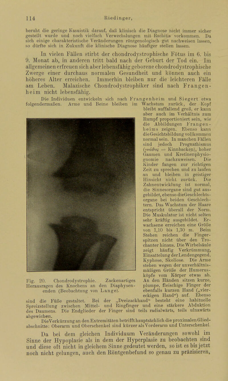 beruht die geringe Kasuistik darauf, daß kliniscli die Diagnose nicht immer sicher gestellt wurde und noch vielfach Verwechslungen mit Rachitis vorkommen. Da sich einige charakteristische Veränderungen röntgenologisch gut nachweisen lassen, so dürfte sich in Zukunft die klinische Diagnose häufiger stellen lassen. In vielen Fällen stirbt der Chondro dystrophische Fötus im 6. bis 9. Monat ab, in anderen tritt bald nach der Geburt der Tod ein. Im allgemeinen erfreuen sich aber lebensfähig geborene chondrodystrophische Zwerge einer durchaus normalen Gesundheit und können auch ein höheres Alter erreichen. Immerhin bleiben nur die leichteren Fälle am Leben. Malazische Chondrodystrophiker sind nach Frangen- heim nicht lebensfähig. Die Individuen entwickeln sich nach Frangenheim und Siegert etwa folgendermaßen. Arme und Beine bleiben im Wachstum zurück, der Kopf bleibt auffallend groß, er kann aber auch im Verhältnis zum Rumpf proportioniert sein, wie die Abbildungen Frangen- heims zeigen. Ebenso kann die Gesichtsbildung vollkommen normal sein. In manchen Fällen sind jedoch Prognathismus (yvd^ag = Kinnbacken), hoher Gaumen und Kretinenphysio- gnomie nachzuweisen. Die Kinder fangen zur richtigen Zeit zu sprechen und zu laufen an und bleiben in geistiger Hinsicht nicht zurück. Die Zalmentwicklung ist normal, die Sinnesorgane sind gut aus- gebildet, ebenso dieGeschlechts- organe bei beiden Geschlech- tern. Das Wachstum der Haare entspricht überall der Norm. Die Muskulatur ist nicht selten sehr kräftig ausgebildet. Er- wachsene erreichen eine Größe von 1,10 bis 1,30 m. Beim Stehen reichen die Finger- spitzen nicht über den Tro- chanter hinaus. Die Wirbelsäule zeigt häufig Verkrümmung, Einsattelung derLendengegend. Kyphose, Skoliose. Die Arme stehen wegen der unverhältnis- mäßigen Große der Humerus- köpfe vom Körper etwas ab. Fig. 20. Ghondrodystrophie. Zackenartiges An den Pländen sitzen kurze. Herausragen des Knochens an den Diaphysen- plumpe, fleischige Finger der enden (Beobachtung von Lange). ebenfalls kurzen Hand („vier- eckigen Hand) auf. Ebenso sind die Füße gestaltet. Bei der „Dreizackhand besteht eine habituelle Spreizstellung zwischen Mittel- und Ringfinger und eine stärkere Abduktion des Daumens. Die Endglieder der Finger sind teils radialwärts, teils ulnawärts abgewichen. _ rn- j DieVerkürzung an den Extremitäten betrifft hauptsächlich die proximalen Glied- abschnitte: Oberarm und Oberschenkel sind kürzer als Vorderarm und Unterschenkel. Da bei dem gleichen Individuum Veränderungen sowohl im Sinne der Hypoplasie als in dem der Hyperplasie zu beobachten sind und diese oft nicht in gleichem Sinne gedeutet werden, so ist es bis jetzt noch nicht gelungen, auch den Köntgenbefund so genau zu präzisieren,