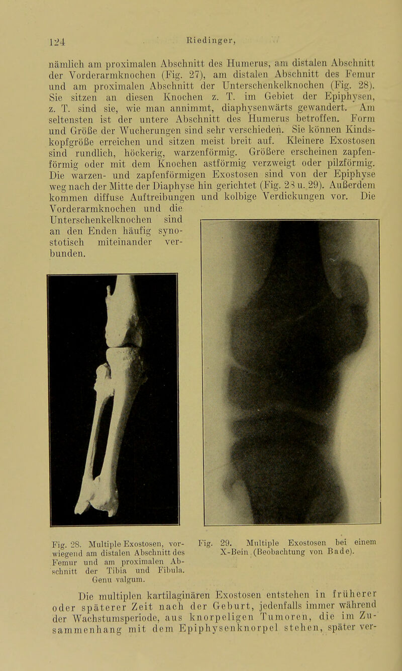 nämlich am proximalen Abschnitt des Humcrus, am distalen Abschnitt der Vorderarmknochen (Fig. 27), am distalen Abschnitt des Femur und am proximalen Abschnitt der Unterschenkelknochen (Fig. 28j. Sie sitzen an diesen Knochen z. T. im Gebiet der Epiphysen, z. T. sind sie, wie man annimmt, diaphysenwärts gewandert. Am seltensten ist der untere Abschnitt des Humerus betroffen. Form und Größe der Wucherungen sind sehr verschieden. Sie können Kinds- kopfgröße erreichen und sitzen meist breit auf. Kleinere Exostosen sind rundlich, höckerig, warzenförmig. Größere erscheinen zapfen- förmig oder mit dem Knochen astförmig verzweigt oder pilzförmig. Die Warzen- und zapfenförmigen Exostosen sind von der Epiphyse weg nach der Mitte der Diaphyse hin gerichtet (Fig. 23 u. 29). Außerdem kommen diffuse Auftreibungen und kolbige Verdickungen vor. Die Vorderarmknochen und die Fig. 28. Multiple Exostosen, vor- Fig. 29. Multiple Exostosen bei einem wiegend am distalen Abschnitt des X-Bein, (Beobachtung von Bade). Femur und am proximalen Ab- schnitt der Tibia und Fibula. Genu valgum. Die multiplen kartilaginären Exostosen entstehen in früherer oder späterer Zeit nach der Geburt, jedenfalls immer während der Wachstumsperiodc, aus knorpeligen Tumoren, die im Zu- sammenhang mit dem Epiphysenknorpcl stehen, später ver-