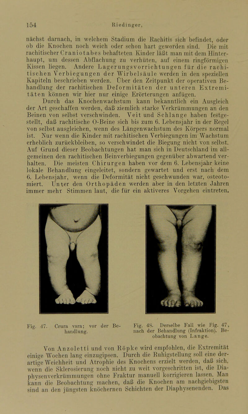 nächst darnach, in welchem Stadium die Eachitis sich befindet, oder üb die Knochen noch weich oder schon hart geworden sind. Die mit rachitischer Craniotabes behafteten Kinder läßt man mit dem Hinter- haupt, um dessen Abflachung zu verhüten, auf einem ringförmigen Kissen liegen. Andere Lagerungsvorrichtungen für die rachi- tischen Verbiegungen der Wirbelsäule werden in den speziellen Kapiteln beschrieben werden. Über den Zeitpunkt der operativen Be- handlung der rachitischen Deformitäten der unteren Extremi- täten können wir hier nur einige Erörterungen anfügen. Durch das Knochenwachstum kann bekanntlich ein Ausgleich der Art geschaffen werden, daß ziemlich starke Verkrümmungen an den Beinen von selbst verschwinden. Veit und Schlange haben festge- stellt, daß rachitische 0-Beine sich bis zum 6. Lebensjahr in der Regel von selbst ausgleichen, wenn des Längenwachstum des Körpers normal ist. Nur wenn die Kinder mit rachitischen Verbiegungen im Wachstum erheblich zurückbleiben, so verschwindet die Biegung nicht von selbst. Auf Grund dieser Beobachtungen hat man sich in Deutschland im all- gemeinen den rachitischen Beinverbiegungen gegenüber abwartend ver- halten. Die meisten Chirurgen haben vor dem 6. Lebensjahr keine lokale Behandlung eingeleitet, sondern gewartet und erst nach dem 6. Lebensjahr, wenn die Deformität nicht geschwunden war, osteoto- miert. Unter den Orthopäden werden aber in den letzten Jahren immer mehr Stimmen laut, die für ein aktiveres Vorgehen eintreten. Fig. 47. Crura vara; vor der Be- P'ig. 48. Derselbe Fall wie Fig. 47, handlung. nach der Behandlung (Infraktion). Be- obachtung von Lange. Von Anzoletti und von Röpke wird empfohlen, die Extremität einige Wochen lang einzugipsen. Durch die Ruhigstellung soll eine der- artige Weichheit und Atrophie des Knochens erzielt werden, daß sich, wenn die Sklerosierung noch nicht zu weit vorgeschritten ist, die Dia- physenverkrümmungen ohne Fraktur manuell korrigieren lassen. Man kann die Beobachtung machen, daß die Knochen am nachgiebigsten sind an den jüngsten knöchernen Schichten der Diaphysenendcn. Das