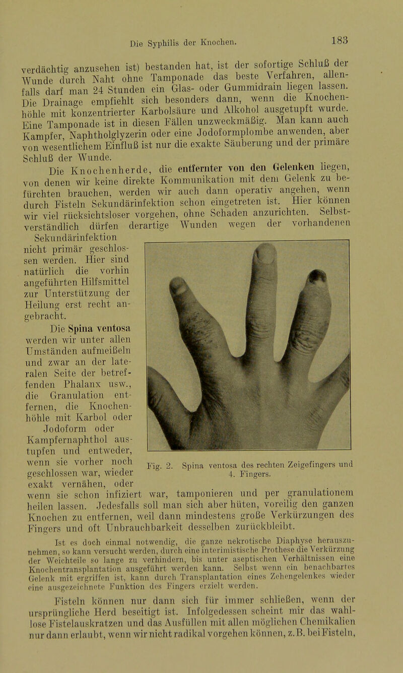 verdächtig anzusehen ist) bestanden hat, ist der sofortige Schluß dei Wunde durch Naht ohne Tamponade das beste Verfahren, aUen- falls darf man 24 Stunden ein Glas- oder Gummidram liegen lassen. Die Drainage empfiehlt sich besonders dann, wenn die Knochen- höhle mit konzentrierter Karbolsäure und Alkohol ausgetupft wurde Eine Tamponade ist in diesen FäUen unzweckmäßig. Man kann auch Kampfer Naphtholglyzerin oder eine Jodoformplombe anwenden, aber von wesentlichem Einfluß ist nur die exakte Säuberung und der primäre Schluß der Wunde. Die Knochenherde, die entfernter von den Gelenken liegen, von denen wir keine direkte Kommunikation mit dem Gelenk zu be- fürchten brauchen, werden wir auch dann operativ angehen, wenn durch Fisteln Sekundärinfektion schon eingetreten ist. Hier können wir viel rücksichtsloser vorgehen, ohne Schaden anzurichten. Selbst- verständhch dürfen derartige Wunden wegen der vorhandenen Sekundärinfektion nicht primär geschlos- sen werden. Hier sind natürlich die vorhin angeführten Hilfsmittel zur Unterstützung der Heilung erst recht an- gebracht. Die Spina ventosa werden wir unter allen Umständen aufmeißeln und zwar an der late- ralen Seite der betref- fenden Phalanx usw., die Granulation ent- fernen, die Knochen- höhle mit Karbol oder Jodoform oder Kampfernaphthol aus- tupfen und entweder, wenn sie vorher noch geschlossen war, wieder exakt vernähen, oder wenn sie schon infiziert war, tamponieren und per granulationein heilen lassen. Jedesfalls soll man sich aber hüten, voreilig den ganzen Knochen zu entfernen, weil dann mindestens große Verkürzungen des Fingers und oft Unbrauchbarkeit desselben zurückbleibt. Ist es doch einmal notwendig, die ganze nekrotische Diaphyse herauszu- nehmen, so kann versucht werden, tlurch eine interimistische Prothese die Verkürzung der Weichteile so lange zu verhindern, bis unter aseptischen Vorhältnissen eine Knochentransplantation ausgeführt werden kann. Selbst wenn ein benaclibarles Gelenk mit ergriffen ist, kann durch Transplantation eines Zeliengeloukes wieder eine ausgezciclintite Funktion des Fingers erzielt werden. Fisteln können nur dann sich für immer schließen, wenn der ursprüngliche Herd beseitigt ist. Infolgedessen scheint mir das wahl- lose Fistelauskratzen und das Ausfüllen mit allen möglichen Cliemikalien nur dann erlaubt, wenn wir nicht radikal vorgehen können, z. B. beiFisteln, Fig. 2. Spina ventosa des rechten Zeigefingers und 4. Fingers.