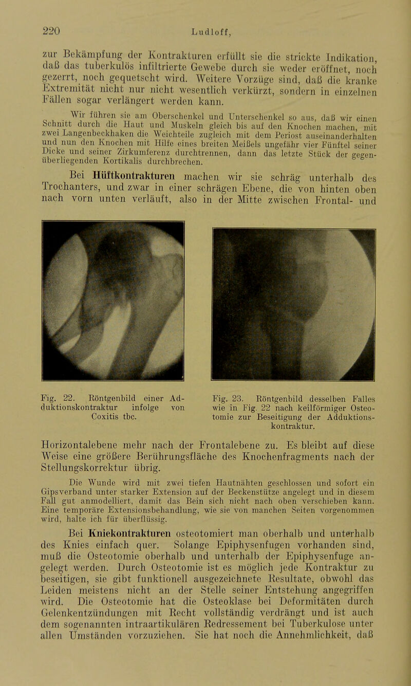 zur Bokänipfung der Kontrakturen erfüllt sie die strickte Indikation, daß das tuberkulös infiltrierte Gewebe durch sie weder eröffnet, noch gezerrt, noch gequetscht wird. Weitere Vorzüge sind, daß die kranke Extremität nicht nur nicht wesentlich verkürzt, sondern in einzelnen Fällen sogar verlängert werden kann. Wir führen sie am Oberschenkel und Unterschenlicl so aus, daß wir einen bchuitt durch die Haut und Muskeln gleich bis auf den Knochen machen, mit zwei Langenbeckhaken die Weichteile zugleich mit dem Periost auseinanderhalten und nun den Knochen mit Hilfe eines breiten Meißels ungefähr vier Fünftel seiner Dicke und seiner Zirkumferenz durchtrennen, dann das letzte Stück der gegen- überliegenden Kortikalis durchbrechen. Bei Hüftkontrakturen machen wir sie schräg unterhalb des Trochanters, und zwar in einer schrägen Ebene, die von hinten oben nach vorn unten verläuft, also in der Mitte zwischen Frontal- und Fig. 22. Röntgenbild einer Ad- Fig. 23. Röntgenbild desselben Falles duktionskontraktur infolge von wie in Fig. 22 nach keilförmiger Osteo- Coxitis tbc. tomie zur Beseitigung der Adduktions- kontraktur. Horizontalebene mehr nach der Frontalebene zu. Es bleibt auf diese Weise eine größere Berührungsfläche des Knochenfragments nach der Stellungskorrektur übrig. Die Wunde wird mit zwei tiefen Hautnähten geschlossen und sofort ein Gipsverband unter starker Extension auf der Beckenstützc angelegt und in diesem Fall gut anmodelliert, damit das Bein sich nicht nach oben verschieben kann. Eine temporäre Extensionsbehandlung, wie sie von manchen Seiten vorgenommen wird, halte ich für überflüssig. Bei Kniekontrakturen osteotomiert man oberhalb und unterhalb des Knies einfach quer. Solange Epiphysenfugen vorhanden sind, muß die Osteotomie oberhalb und unterhalb der Epiphysenfuge an- gelegt werden. Durch Osteotomie ist es möglich jede Kontraktur zu beseitigen, sie gibt funktionell ausgezeichnete Resultate, obwohl das Leiden meistens nicht an der Stelle seiner Entstehung angegriffen wird. Die Osteotomie hat die Osteoklase bei Deformitäten durch Gelenkentzündungen mit Recht vollständig verdrängt und ist auch dem sogenannten intraartikulären Redressement bei Tuberkulose unter allen Umständen vorzuziehen. Sie hat noch die Annehmlichkeit, daß