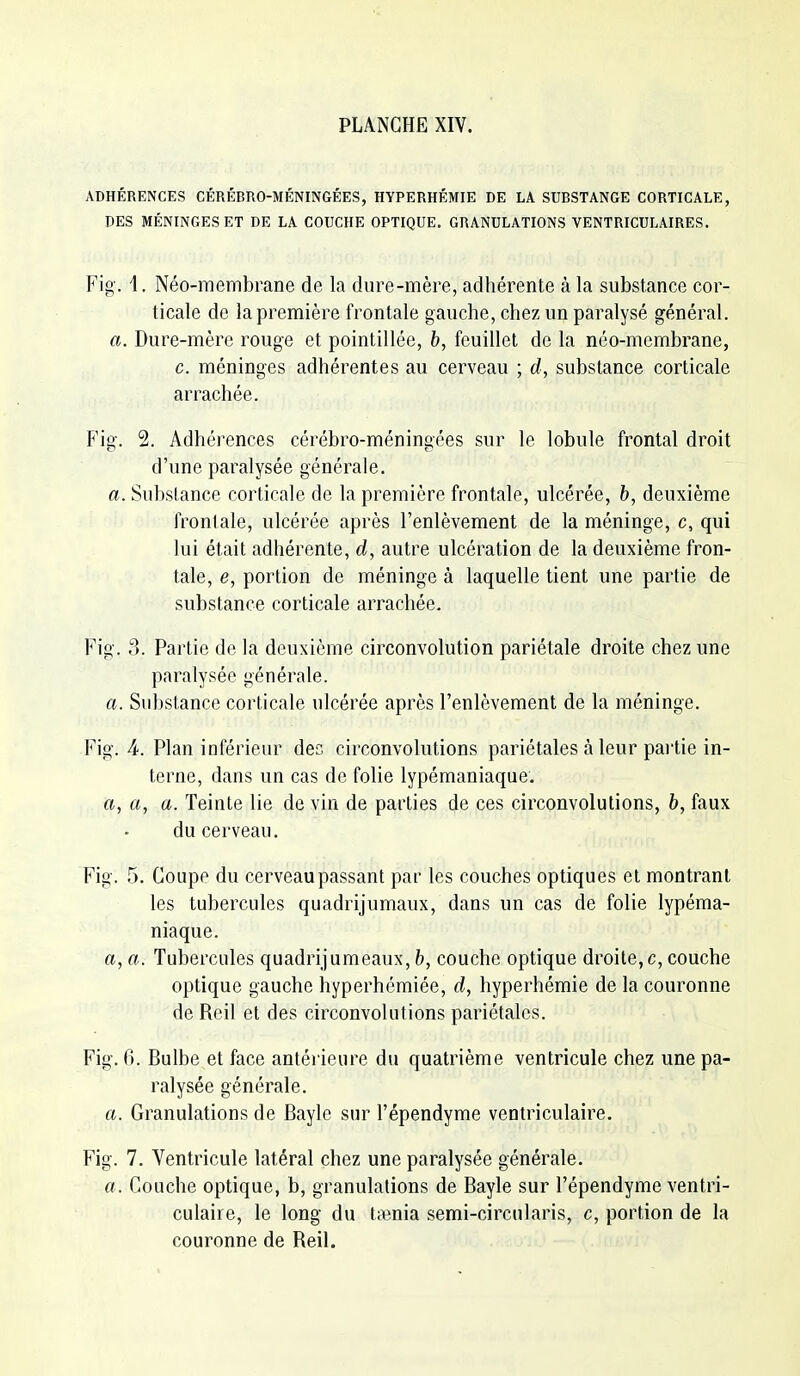 ADHÉRENCES CÉRÉBRO-MÉNINGÉES, HYPERHÉMIE DE LA SUBSTANCE CORTICALE, DES MÉNINGES ET DE LA COUCHE OPTIQUE. GRANULATIONS VENTRICULAIRES. Fig. 1. Néo-membrane de la dure-mère, adhérente à la substance cor- ticale de la première frontale gauche, chez un paralysé général. a. Dure-mère rouge et pointillée, h, feuillet de la néo-membrane, c. méninges adhérentes au cerveau ; rf, substance corticale arrachée. Fig. 2. Adhérences cérébro-méningées sur le lobule frontal droit d'une paralysée générale. a. Substance corticale de la première frontale, ulcérée, 6, deuxième frontale, ulcérée après l'enlèvement de la méninge, c, qui lui était adhérente, d, autre ulcération de la deuxième fron- tale, e, portion de méninge à laquelle tient une partie de substance corticale arrachée. Fig. 3. Partie de la deuxième circonvolution pariétale droite chez une paralysée générale. a. Substance corticale ulcérée après l'enlèvement de la méninge. Fig. 4. Plan inférieur des circonvolutions pariétales à leur pai'tie in- terne, dans un cas de folie lypémaniaque. a, a, a. Teinte lie de vin de parties de ces circonvolutions, b, faux du cerveau. Fig. .5. Coupe du cerveau passant par les couches optiques et montrant les tubercules quadrijumaux, dans un cas de folie lypéma- niaque. a, a. Tubercules quadrijumeaux, b, couche optique droite,c, couche optique gauche hyperhémiée, d, hyperhémie de la couronne de Reil et des circonvolutions pariétales. Fig. 6. Bulbe et face antéi ieure du quatrième ventricule chez une pa- ralysée générale. a. Granulations de Bayle sur l'épendyme ventriculaire. Fig. 7. Ventricule latéral chez une paralysée générale. a . Couche optique, b, granulations de Bayle sur l'épendyme ventri- culaire, le long du taenia semi-circularis, c, portion de la couronne de Reil.