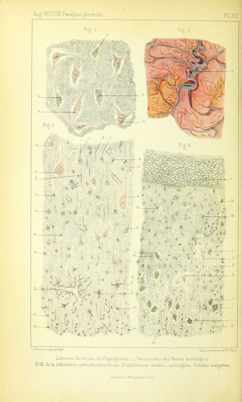 m J.Benoist ad.nat.del Jmp.UmercieriiC'=,Pans Lésions du noyau de l'hypoglosse Yaricosiiés des Veines méningées. Etat delà substance corticale dans le cas d'adhérences cérébro-méningées, Cellules araignées.