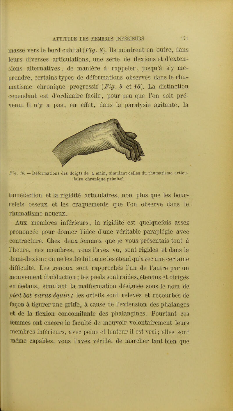 masse vers le bord cubital [Fig. 8). Ils montrent en outre, dans leurs diverses articulations, une série de flexions et d'exten- sions alternatives, de manière à rappeler, jusqu'à s'y mé- prendre, certains types de déformations observés dans le rhu- matisme clironique progressif {Fig. 9 et 10). La distinction cependant est d'ordinaire facile, pour peu que l'on soit pré- venu. Il n'y a pas, en effet, dans la paralysie agitante, la Fiff. 10. — Déformations des doigts de a main, simulant celles du rhumatisme articu- laire chronique primitif. tuméfaction et la rigidité articulaires, non plus que les bour- relets osseux et les craquements que l'on observe dans le. rbimiatisme noueux. Aux membres inférieurs, la rigidité est quelquefois assez prononcée pour donner l'idée d'une véritable paraplégie avec contracture. Cliez deux femmes que je vous présentais tout à l'heure, ces membres, vous l'avez vu, sont rigides et dans la demi-flexion ; on ne les fléchit ou ne les étend qu'avec une certaine difficulté. Les genoux sont rapprochés l'un de l'autre par un mouvement d'adduction ; les pieds sont raides, étendus et dirigés en dedans, simulant la malformation désignée sous le nom de pied dot vanis équin ; les orteils sont relevés et recourbés de façon à figurer une grifle, à cause de l'extension des phalanges et de la flexion concomitante des phalangines. Pourtant ces femmes ont encore la faculté de mouvoir volontairement leurs membres inférieurs, avec peine et lenteur il est vrai; elles sont même capables, vous l'avez vérifié, de marcher tant bien que L