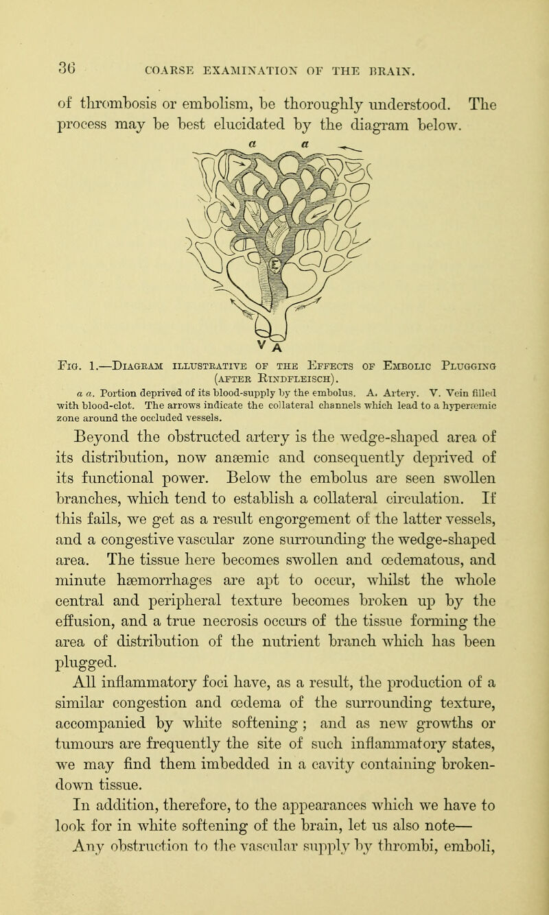of tliroml)Osis or embolism, be tborougbly understood. The process may be best elucidated by the diagram below. Fig. 1.—Diagram illustrative of the Effects of Embolic Plugging (after Rindfleisch) . a a. Portion deprived of its blood-supply by the embolus. A. Artery. V. Vein filled ■with blood-clot. The arrows indicate the collateral channels which lead to a hyperremic zone around the occluded vessels. Beyond the obstructed artery is the wedge-shaped area of its distribution, now anaemic and consequently deprived of its functional power. Below the embolus are seen swollen branches, which tend to establish a collateral circulation. If this fails, we get as a result engorgement of the latter vessels, and a congestive vascular zone surrounding the wedge-shaped area. The tissue here becomes swollen and oedematous, and minute haemorrhages are apt to occur, whilst the whole central and peripheral texture becomes broken up by the effusion, and a true necrosis occurs of the tissue forming the area of distribution of the nutrient branch which has been plugged. All inflammatory foci have, as a result, the production of a similar congestion and oedema of the siuTounding textui'e, accompanied by white softening ; and as new growths or tumours are frequently the site of such inflammatory states, we may find them imbedded in a cavity containing broken- down tissue. In addition, therefore, to the appearances which we have to look for in white softening of the brain, let us also note— Any obstruction to tlie vascular supply by thrombi, emboli,