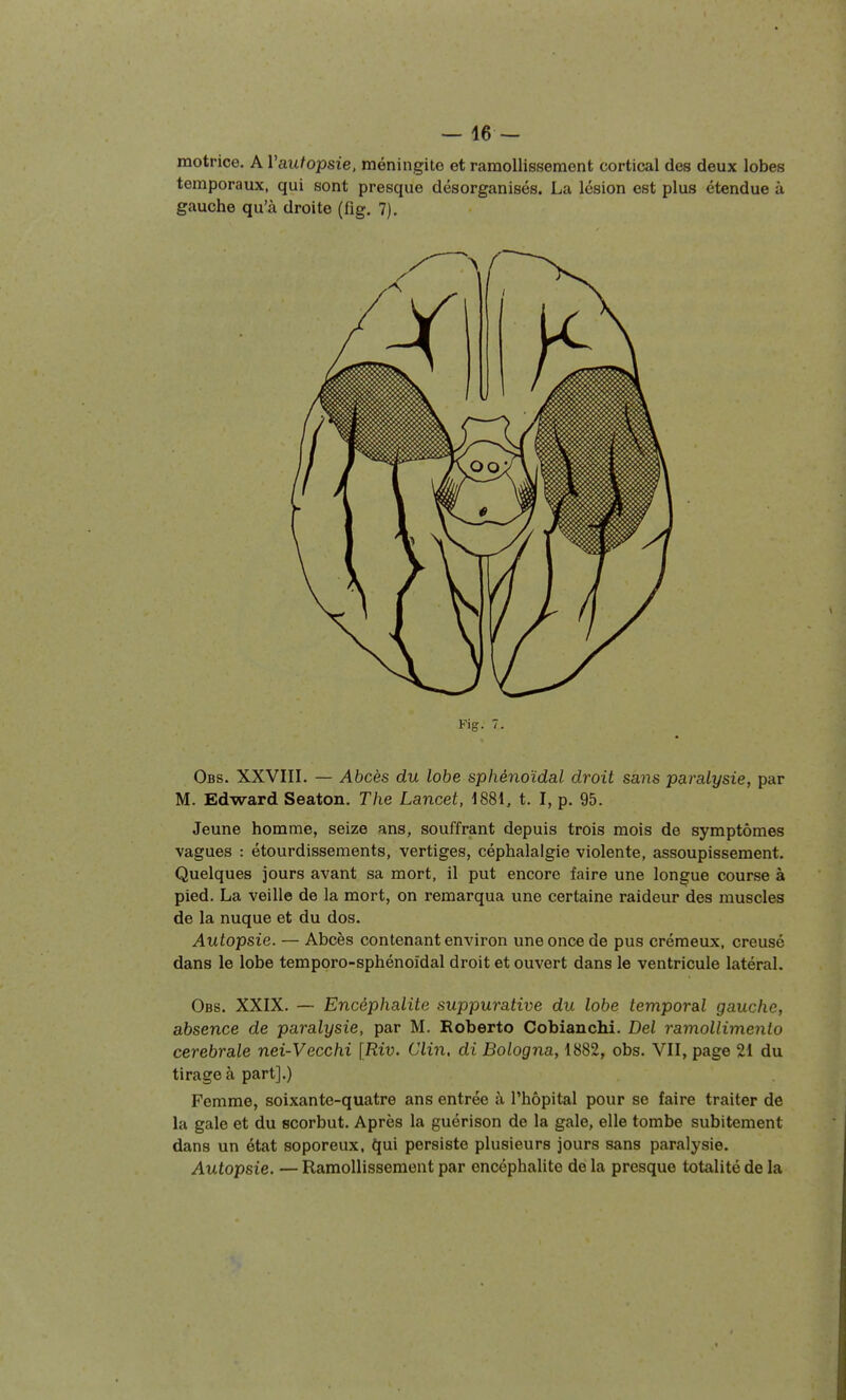 motrice. A Vautopsie, méningite et ramollissement cortical des deux lobes temporaux, qui sont presque désorganisés. La lésion est plus étendue à gauche qu'à droite (fig. 7). Fig. 7. Obs. XXVIII. — Abcès du lobe sphénoïdal droit sans paralysie, par M. Edward Seaton. The Lancet, 1881, t. I, p. 95. Jeune homme, seize ans, souffrant depuis trois mois de symptômes vagues : étourdissements, vertiges, céphalalgie violente, assoupissement. Quelques jours avant sa mort, il put encore faire une longue course à pied. La veille de la mort, on remarqua une certaine raideur des muscles de la nuque et du dos. Autopsie. — Abcès contenant environ une once de pus crémeux, creusé dans le lobe temporo-sphénoïdal droit et ouvert dans le ventricule latéral. Obs. XXIX. — Encéphalite suppurative du lobe temporal gauche, absence de paralysie, par M. Roberto Gobianchi. Del ramollimento cérébrale nei-Vecchi [Riv. Clin, di Bologna, 1882, obs. VII, page 21 du tirage à part].) Femme, soixante-quatre ans entrée à l'hôpital pour se faire traiter de la gale et du scorbut. Après la guérison de la gale, elle tombe subitement dans un état soporeux. persiste plusieurs jours sans paralysie. Autopsie. — Ramollissement par encéphalite de la presque totalité de la