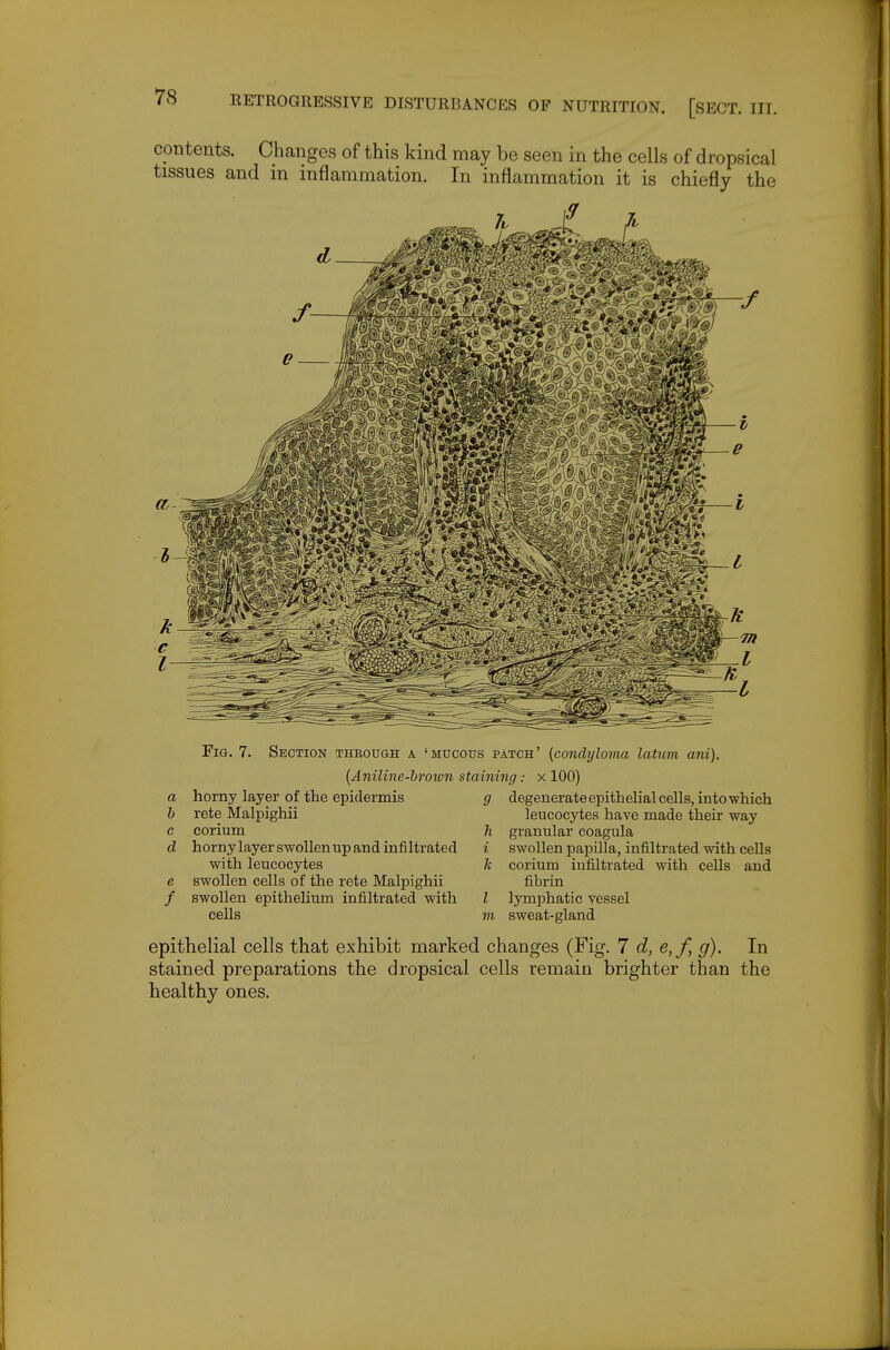 contents. Changes of this kind may be seen in the cells of dropsical tissues and in inflammation. In inflammation it is chiefly the Fig. 7. Section theough a 'mucous patch' {condyloma latum ani). {Aniline-brown staining: x 100) a b horny layer of the epidermis rete Malpighii c corium d horny layer swollen up and infi Itrated with leucocytes e swollen cells of the rete Malpighii / swollen epithehum infiltrated with cells g degenerate epithelial cells, into which leucocytes have made their way h granular coagula i swollen papilla, infiltrated with cells 7c corium infiltrated with cells and fibrin I lymphatic vessel m sweat-gland epithelial cells that exhibit marked changes (Fig. 7 d, e,f, g). In stained preparations the dropsical cells remain brighter than the healthy ones.