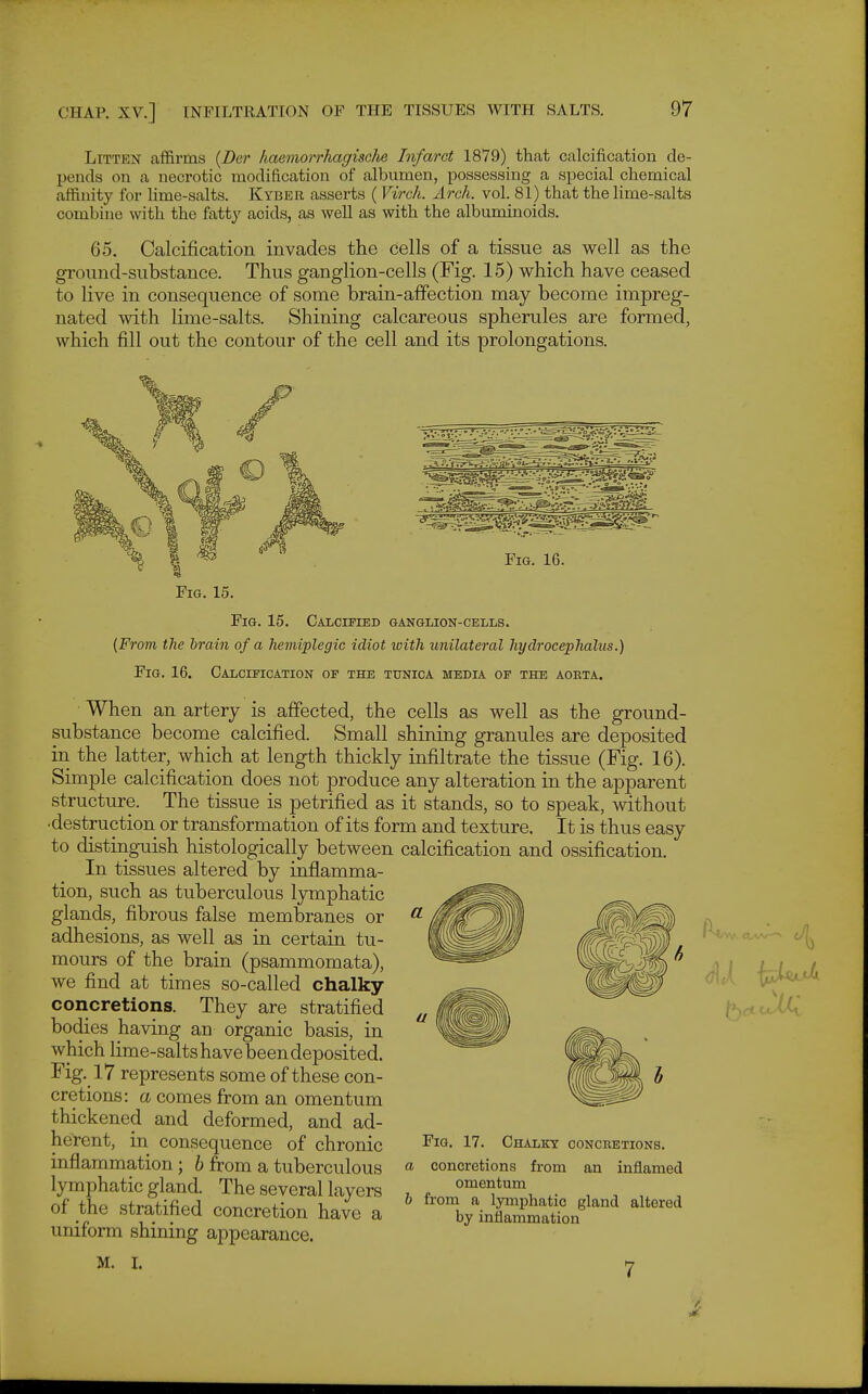 LiTTEN affirms {Der liaemorrhagisclie Infarct 1879) thcat calcification de- pends on a necrotic modification of albumen, possessing a special chemical affinity for lime-salts. Kyber asserts (Virch. Arch. vol. 81) that the lime-salts combine with the fatty acids, as well as with the albuminoids. 65. Calcification invades the cells of a tissue as well as the ground-substance. Thus ganglion-cells (Fig. 15) which have ceased to live in consequence of some brain-affection may become impreg- nated with lime-salts. Shining calcareous spherules are formed, which fill out the contour of the cell and its prolongations. ^^^^^^^^^^^^^ Fig. 16. Fig. 15. Calcified ganglion-cells. (From the brain of a hemiplegic idiot loith unilateral hydrocephalus.) Fig. 16. Calcification of the tunica media of the aokta. When an artery is affected, the cells as well as the ground- substance become calcified. Small shining granules are deposited in the latter, which at length thickly infiltrate the tissue (Fig. 16). Simple calcification does not produce any alteration in the apparent structure. The tissue is petrified as it stands, so to speak, without •destruction or transformation of its form and texture. It is thus easy to distinguish histologically between calcification and ossification. In tissues altered by inflamma- tion, such as tuberculous lymphatic glands, fibrous false membranes or adhesions, as well as in certain tu- mours of the brain (psammomata), we find at times so-called chalky concretions. They are stratified bodies having an organic basis, in which lime-salts have been deposited. Fig. 17 represents some of these con- cretions: a comes from an omentum thickened and deformed, and ad- herent, in consequence of chronic inflammation; 6 from a tuberculous lymphatic gland. The several layers of the stratified concretion have a uniform shining appearance. M. L Fig. 17. Chalky concretions. concretions from an inflamed omentum from a lymphatic gland altered by inflammation ■it