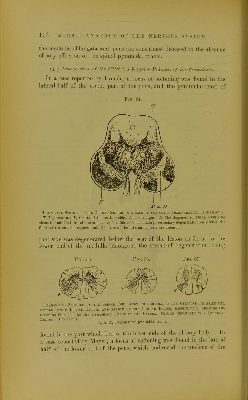 the medulla oblongata and pons are sometimes diseased in the absence of an v affection of the spinal pyramidal tracts. (jj) Degeneration of the Fillet and Superior Peduncle of the Cerebellum. In a case reported by Homen, a focus of softening was found in the lateral half of the upper part of the pons, arid the pyramidal tract of Fig 54. nr F F L D Horizontal Section or the Crura Cerebri in a case of Secondary Degeneration. (Charcot ) T, Tegmentum ; F, Crusta of the healthy side; L, Locus niger ; D, The degenerated fibres, occupying about the middle third of the crusta; P, The fibres which undergo secondary degeneration only when the fibres of the anterior segment and the knee of the internal capsule are diseased that side was degenerated below the seat of the lesion as far as to the lower end of the medulla oblongata, the streak of degeneration being Fig. 55. Fig. 56. Fig. 57. Transverse Sections of the Spinal Conn, from the middle of the Cervical Enlargement, middle of the Dorsal Region, and middle of the Lumbar Region, respectively, showing De- scending Sclerosis of the Pyramidal Tract in the Lateral Column Secondary to a Cerebral Lesion. (Charcot.) . A, A, A, Degenerated pyramidal tracts. found in the part which lies to the inner side of the olivary body. In a case reported by Meyer, a focus of softening was found in the lateral half of the lower part of the pons, which embraced the nucleus of the