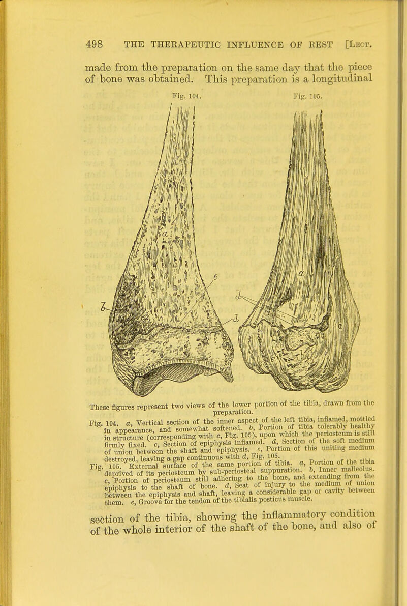 made from the preparation on tlie same day tliat the piece of bone was obtained. This preparation is a longitudinal Fig. 104. Fig. 105. These fleures represent two views of the lower portion of the tihia, dravNTi from the preparation. Vi<T ini n Vprtical section of the inner aspect of the left tibia, inflamed, mottled ^^^ Veailnc^and o°iSewha^ softeued/ft, Portion of tiljia tolerably healtl^y n BtEre rcorrespondmg with c, Fig. 105), upon which the periosteum is stiU flrm^lv fixed c Section of epiphysis inflamed, d, Section of the soft medium ^Son between thrshaft aJ eVpbysis. e. Portion of this nnitmg medium destroyed, leaving a gap continuous with ct, I'lg. 105. r n „ *ik:» Fig. 105. Eiteraal surface of the same portion of tibia, a, Portion of the t bia deprived of its periosteum by sub-periosteal suppuration. &, Inner malleolus. r prtL of periosteum still adhering to the bone, and extending from the epiSrto tSe shaft of bone, d, Seat of injury to the medium of union Sen the epiphysis and shaft, leaving a considerable gap or cavity between them, e, Groove for the tendon of the tibiahs posticus muscle. section of the tibia, showing the inflammatory condition of the whole interior of the shaft of the bone, and also of