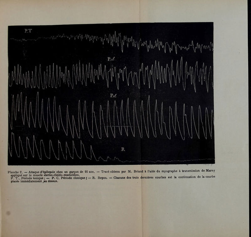 appliqué sur le muscle stemo-cleido-mastoïdien. i- a i „„ P T., Période tonique ; — P. C. Période cloniquc ; — R. Repos. — Chacune des trois dernières courbes est la continuation de la courDe placée immédiatement ,aa dessus.