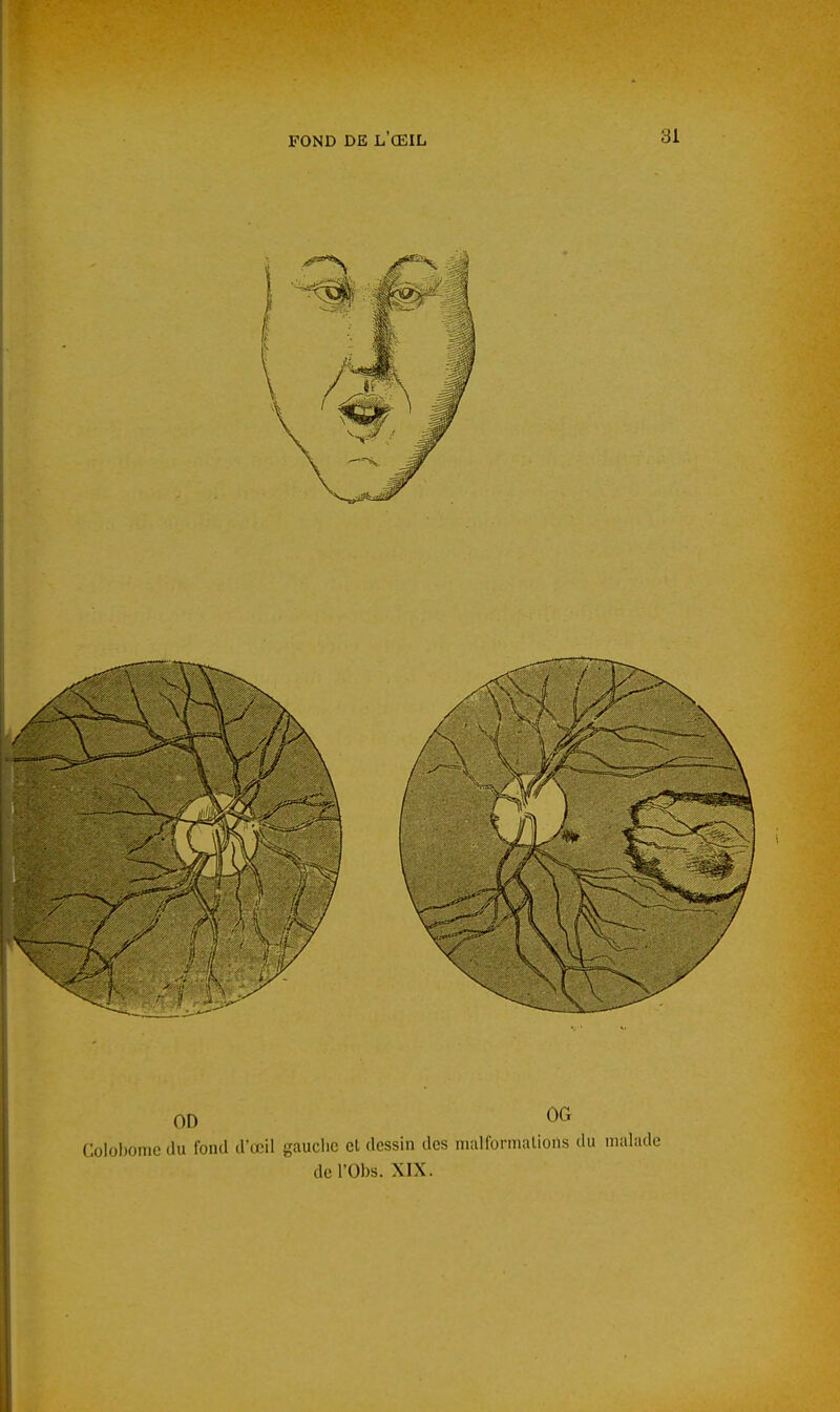 OD OG Colobome du fond d'œil gauche et dessin des malformations du malii de l'Obs. XIX.