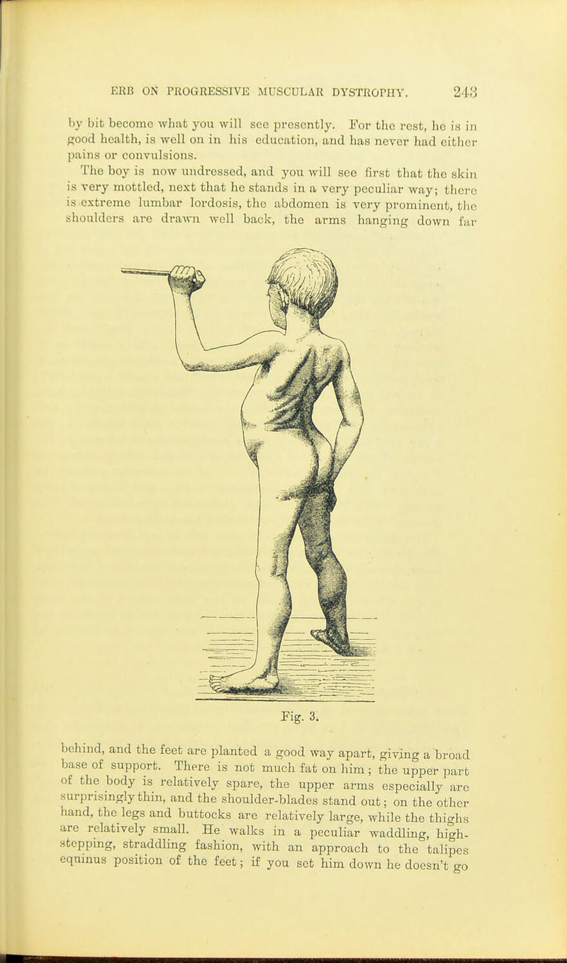 by bit become what you will see presently. For the rest, he is in <TOod health, is well on in his education, and has never had either l)ains or convulsions. The boy is now undressed, and you will see first that the skin is very mottled, next that he stands in a very peculiar way; there is extreme lumbar lordosis, the abdomen is very prominent, the shoulders are drawn well back, the arms hanging down far Fig. 3. behind, and the feet are planted a good way apart, giving a broad base of support. There is not much fat on him ; the upper part of the body is relatively spare, the upper arms especially are surprismglythin, and the shoulder-blades stand out; on the other hand, the legs and buttocks are relatively large, while the thighs are relatively small. He walks in a peculiar waddling, high- steppmg, straddling fashion, with an approach to the talipes cqnmus position of the feet; if you set him down he doesn't go