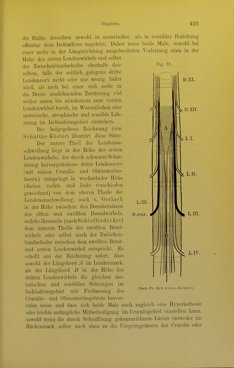 Fig. Bl. wechselnder Höhe Hnks verschieden oberen Theile der nach V. Gerlach N.crur. D.XTI. die Hälfte derselben sowohl in motorischer, als in sensibler Beziehung offenbar dem Ischiadicns zugehört. Daher muss beide Male, sowohl bei einer mehr in der Längsrichtung ausgebreiteten Verletzung etwa in der Höhe des ersten Lendenwirbels nnd selbst der Zvvischenbandscheibe oberhalb des- selben, falls der seitlich gelegene dritte Lendennerv- nicht oder nur wenig lädirt llllh-—IIII D.XI. wird, als auch bei einer sich mehr in die Breite ausdehnenden Zerstörung viel weiter unten bis mindestens zum vierten Lendenwirbel herab, im Wesentlichen eine motorische, atrophische nnd sensible Läh- mung im Isehiadicusgebiet entstehen. Die beigegebene Zeichnung (von Schultze-Köster) illustrirt diese Sätze. Der untere Theil der Lendenan- schweUung liegt in der Höhe des ersten Lendenwirbels; der durch schwarze Schat- tirung hervorgehobene dritte Lendennerv (mit seinen Cruralis- und Obturatorius- lasern) entspringt in (darum rechts und gezeichnet) von dem Lendenanschwellung, in der Höhe zwischen den Dornfortsätzen des elften und zwölften Dorsalwirbels, welche ihrerseits (nach S c h i e f f e r deck e r) dem unteren Theile des zwölften Brust- wirbels oder selbst noch der Zwischen- bandscheibe zwischen dem zwölften Brust- und ersten Lendenwirbel entspricht. Es erhellt aus der Zeichnung sofort, dass sowohl der Längsherd Ä im Lendenmark, als der Längsherd 1^ in der Höhe des dritten Lendenwirbels die gleichen torischen und sensiblen Störungen Isehiadicusgebiet mit Freilassung mo- im des i.n. L.iir. L.IV (Nach Fr. Sch u 11 ze- Kiister.) Cruralis- und Obturatoriusgebiets hervor- rufen muss und dass sich beide Male auch zugleich eine Hyperästhesie oder leichte anfängliche Mitbetheiliguug im Cruralisgebiet einstellen kann, sowohl wenn die durch SchralTirung gekennzeichnete Läsion entweder im Rückenmark selbst nach oben zu die LTrsprungsfasern des Cruralis oder