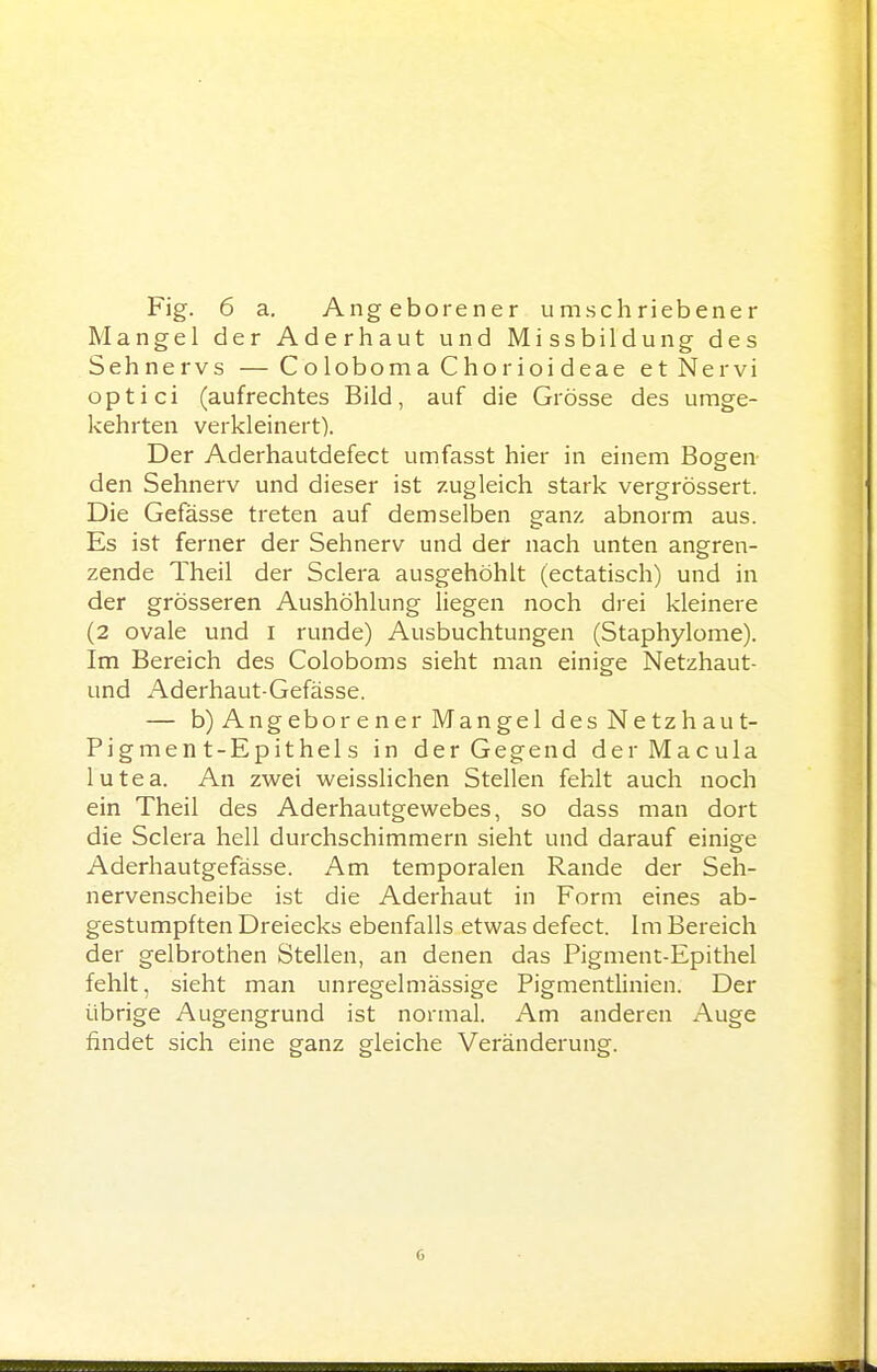 Mangel der Aderhaut und Missbildung des Sehnervs —Co loboma Chor ioi deae et Nervi optici (aufrechtes Bild, auf die Grösse des umge- kehrten verkleinert). Der Aderhautdefect umfasst hier in einem Bogen den Sehnerv und dieser ist zugleich stark vergrössert. Die Gefässe treten auf demselben ganz abnorm aus. Es ist ferner der Sehnerv und der nach unten angren- zende Theil der Sclera ausgehöhlt (ectatisch) und in der grösseren Aushöhlung liegen noch drei kleinere (2 ovale und l runde) Ausbuchtungen (Staphylome). Im Bereich des Coloboms sieht man einige Netzhaut- und Aderhaut-Gefässe. — b) Angeborener Mangel des Netzhaut- Pigmen t-Epithel s in der Gegend der Macula lutea. An zwei weisslichen Stellen fehlt auch noch ein Theil des Aderhautgewebes, so dass man dort die Sclera hell durchschimmern sieht und darauf einige Aderhautgefässe. Am temporalen Rande der Seh- nervenscheibe ist die Aderhaut in Form eines ab- gestumpften Dreiecks ebenfalls etwas defect. Im Bereich der gelbrothen Stellen, an denen das Pigment-Epithel fehlt, sieht man unregelmässige Pigmentlinien. Der übrige Augengrund ist normal. Am anderen Auge findet sich eine ganz gleiche Veränderung.