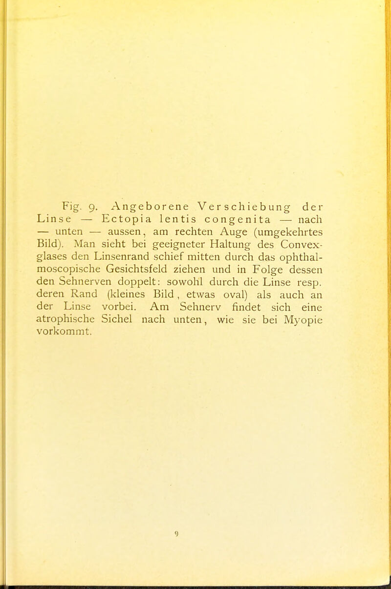 Linse — Ectopia lentis congenita — nach — unten — aussen, am rechten Auge (umgekehrtes Bild). Man sieht bei geeigneter Haltung des Convex- glases den Linsenrand schief mitten durch das ophthal- moscopische Gesichtsfeld ziehen und in Folge dessen den Sehnerven doppelt: sowohl durch die Linse resp. deren Rand (kleines Bild, etwas oval) als auch an der Linse vorbei. Am Sehnerv findet sich eine atrophische Sichel nach unten, wie sie bei Myopie vorkommt. 9