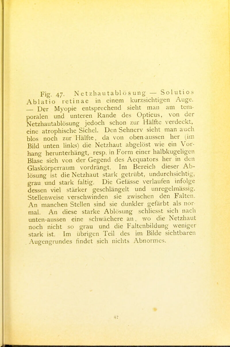 Fig. 47- Netzhautablösung — Solutios Ablatio retinae in einem kurzsichtigen Auge. Der Myopie entsprechend sieht man am tem- poralen und unteren Rande des Opticus, von der Netzhautablösung jedoch schon zur Hälfte verdeckt, eine atrophische Sichel. Den Sehnerv sieht man auch blos noch zur Hälfte, da von obenaussen her (im Bild unten hnks) die Netzhaut abgelöst wie ein Vor- hang herunterhängt, resp. in Form einer halbkugeUgen Blase sich von der Gegend des Aequators her in den Glaskörperraum vordrängt. Im Bereich dieser Ab- lösung ist die Netzhaut stark getrübt, undurchsichtig, grau und stark faltig. Die Gelässe verlaufen infolge dessen viel stärker geschlängelt und unregelmässig. Stellenweise verschwinden sie zwischen den Falten. An manchen Stellen sind sie dunkler gefärbt als nor- mal. An diese starke Ablösung schliesst sich nach unten-aussen eine schwächere an, wo die Netzhaut noch nicht so grau und die Faltenbildung weniger stark ist. Im übrigen Teil des im Bilde sichtbaren Augengrundes findet sich nichts Abnormes. »