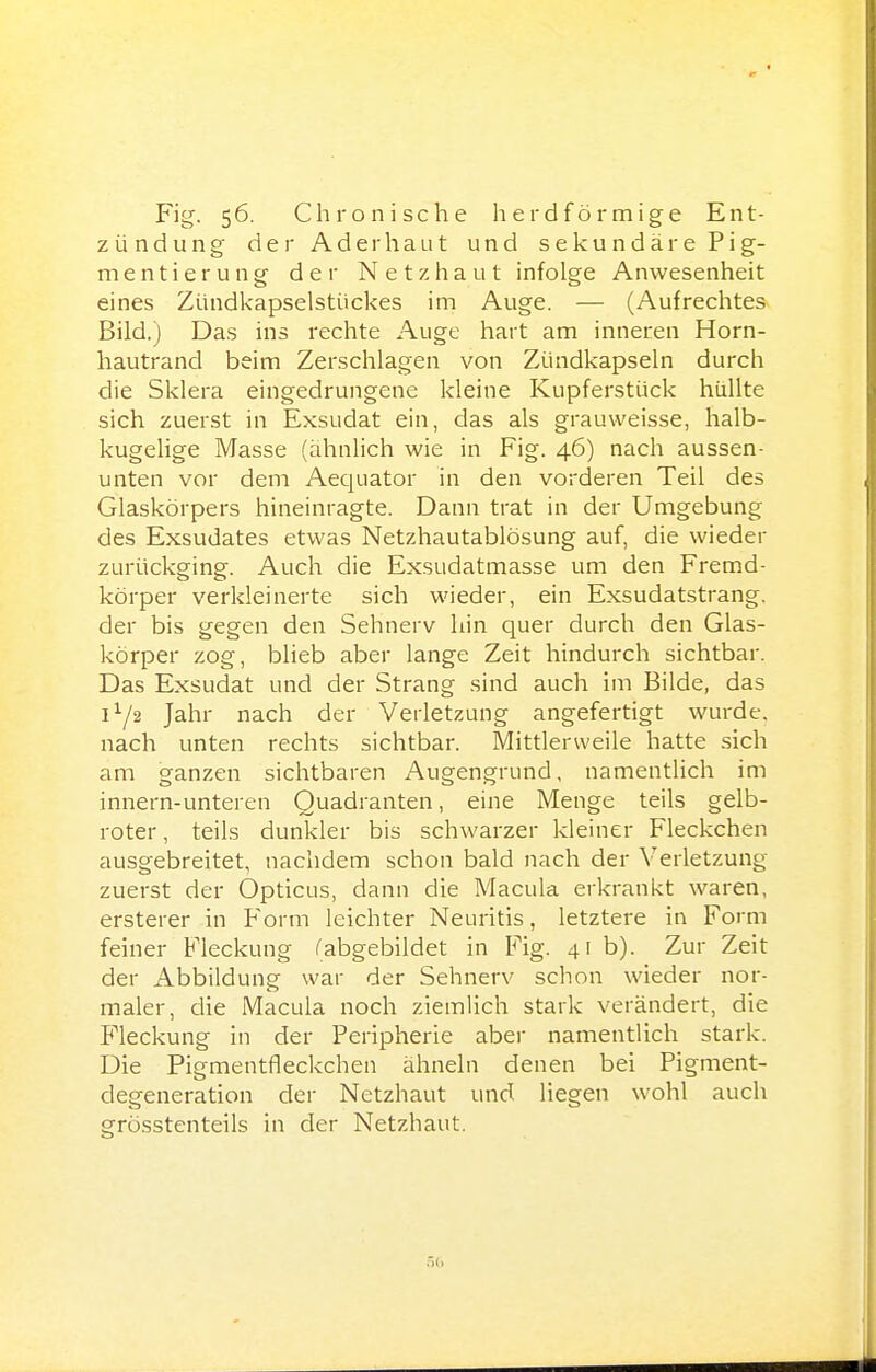 Fig. 56. Chronische herdförmige Ent- zündung der Aderhaut und s e ku n d är e P i g- mentierung der Netzhaut infolge Anwesenheit eines Zündkapselstückes im Auge. — (Aufrechtes Bild.) Das ins rechte Auge hart am inneren Horn- hautrand beim Zerschlagen von Zündkapseln durch die Sklera eingedrungene kleine Kupferstück hüllte sich zuerst in Exsudat ein, das als grauweisse, halb- kugehge Masse (ähnlich wie in Fig. 46) nach aussen- unten vor dem Aequator in den vorderen Teil des Glaskörpers hineinragte. Dann trat in der Umgebung des Exsudates etwas Netzhautablösung auf, die wieder zurückging. Auch die Exsudatmasse um den Fremd- körper verkleinerte sich wieder, ein Exsudatstrang, der bis gegen den Sehnerv hin quer durch den Glas- körper zog, blieb aber lange Zeit hindurch sichtbar. Das Exsudat und der Strang sind auch im Bilde, das 1^/2 Jahr nach der Verletzung angefertigt wurde, nach unten rechts sichtbar. Mittlerweile hatte sich am ganzen sichtbaren Augengrund, namentlich im innern-unteren Quadranten, eine Menge teils gelb- roter, teils dunkler bis schwarzer kleiner Fleckchen ausgebreitet, nachdem schon bald nach der Verletzung zuerst der Opticus, dann die Macula erkrankt waren, ersterer in Form leichter Neuritis, letztere in Form feiner Fleckung (abgebildet in Fig. 41 b). Zur Zeit der Abbildung war der Sehnerv schon wieder nor- maler, die Macula noch ziemlich stark verändert, die Pleckung in der Peripherie aber namentlich stark. Die Pigmentfleckchen ähneln denen bei Pigment- degeneration der Netzhaut und liegen wohl auch grösstenteils in der Netzhaut.