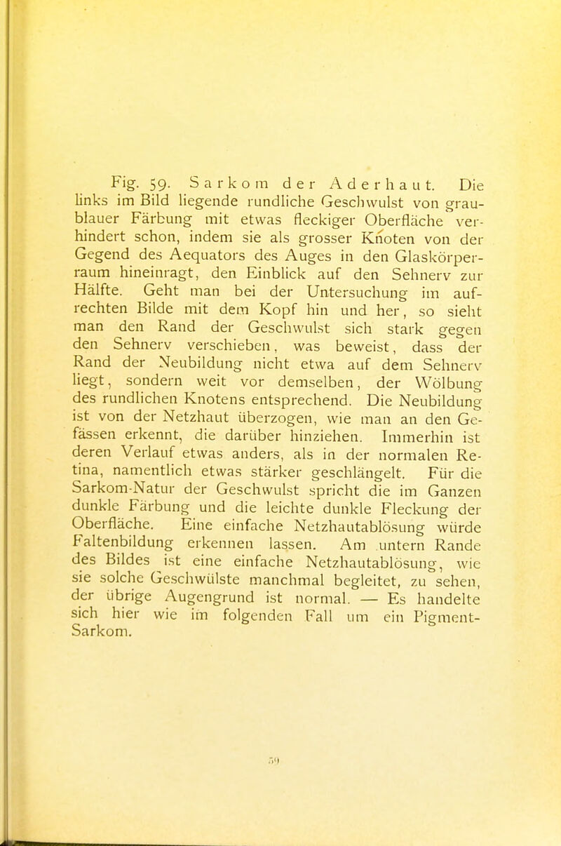 links im Bild liegende rundliche Geschwulst von grau- blauer Färbung mit etwas fleckiger Oberfläche' ver- hindert schon, indem sie als grosser Ktioten von der Gegend des Aequators des Auges in den Glaskörper- raum hineinragt, den Einblick auf den Sehnerv zur Hälfte. Geht man bei der Untersuchung im auf- rechten Bilde mit dem Kopf hin und her, so sieht man den Rand der Geschwulst sich stark gegen den Sehnerv verschieben, was beweist, dass der Rand der Neubildung nicht etwa auf dem Sehnerv liegt, sondern weit vor demselben, der Wölbung des rundlichen Knotens entsprechend. Die Neubildung ist von der Netzhaut überzogen, wie man an den Ge- fässen erkennt, die darüber hinziehen. Immerhin ist deren Verlauf etwas anders, als in der normalen Re- tina, namentlich etwas stärker geschlängelt. Für die Sarkom-Natur der Geschwulst spricht die im Ganzen dunkle Färbung und die leichte dunkle Fleckung der Oberfläche. Eine einfache Netzhautablösung würde Faltenbildung erkennen lassen. Am untern Rande des Bildes ist eine einfache Netzhautablösung, wie sie solche Geschwülste manchmal begleitet, zu sehen, der übrige Augengrund ist normal. — Es handelte sich hier wie im folgenden Fall um ein Pigment- Sarkom.