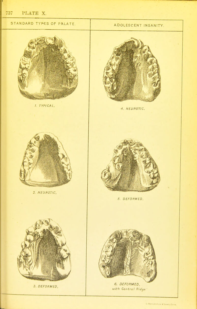 STANDARD TYPES OF PALATE 3. DEFORMED. ADOLESCENT INSANITY. 6, DEFORMED, with Central Ridgf