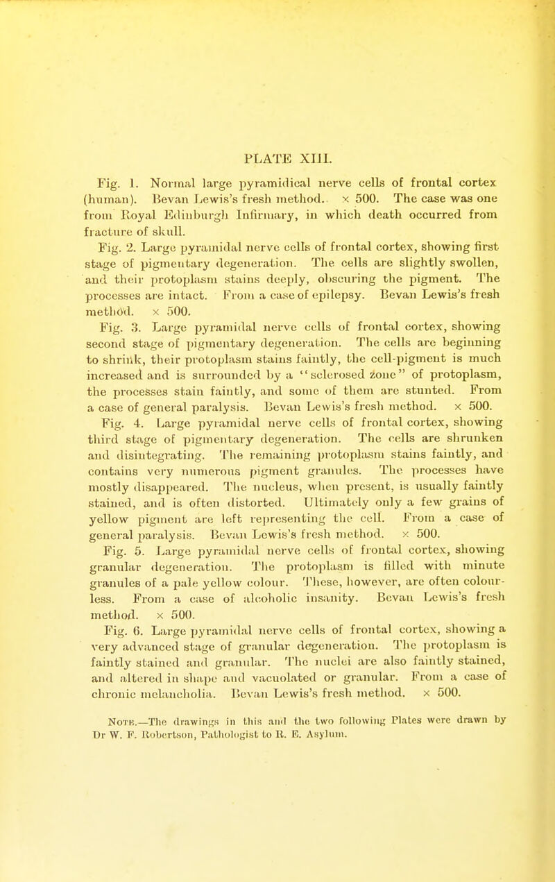 Fig. 1. Normal large pyramidical nerve cells of frontal cortex (human). Bevan Lewis's fresh method., x 500. The case was one from Royal Edinburgli Infirmary, in which death occurred from fracture of skull. Fig. 2. Large pyramidal nerve cells of frontal cortex, showing first stage of pigmentary degeneration. The cells are slightly swollen, and their protoplasm stains deeply, obscuring the pigment. The processes are intact. From a case of epilepsy. Bevan Lewis's fresh method. X 500. Fig. 3. Large pyramidal nerve cells of frontal cortex, showing second stage of pigmentary degeneration. The cells are beginning to shrir.k, their protoplasm stains faintly, the cell-pigment is much increased and is surrounded by a sclerosed zone of protoplasm, the processes stain faintly, and some of them are stunted. From a case of general paralysis. Bevan Lewis's fresh method. x 500. Fig. 4. Large pyramidal nerve cells of frontal cortex, showing third stage of pigmentary degeneration. The cells are shrunken and disintegrating. The remaining protoplasm stains faintly, and contains very numerous pigment granules. The processes have mostly disappeared. The nucleus, wlien present, is usually faintly stained, and is often distorted. Ultimately only a few grains of yellow pigment are loft re])rcsenting the cell. From a case of general paralysis. Bcviin Lewis's fresh method. x 500. Fig. 5. Jjarge pyramidal nerve cells of fiouUi,! cortex, showing granular degeneration. Tlie protojdaam is filled with minute granules of a pale yellow colour. These, however, arc often colour- less. From a case of alcoholic insanity. Bevan Lewis's frcsli method. X 500. Fig. 6. Large pyramidal nerve cells of frontal cortex, sliowing a very advanced stage of granular degeneration. '^Phe protoplasm is faintly stained and granidar. The i\uclei are also faintly stained, and altered in shape and vacuolated or granular. From a case of chronic melancholia. Bevan Lewis's fresh method. x 500. NoTK.—Till) (IrawinKK hi lliis ami the two following Plates were drawn by Dr W. F. Uobcrtson, PiiUioliijji.st to U. R. Asylum.