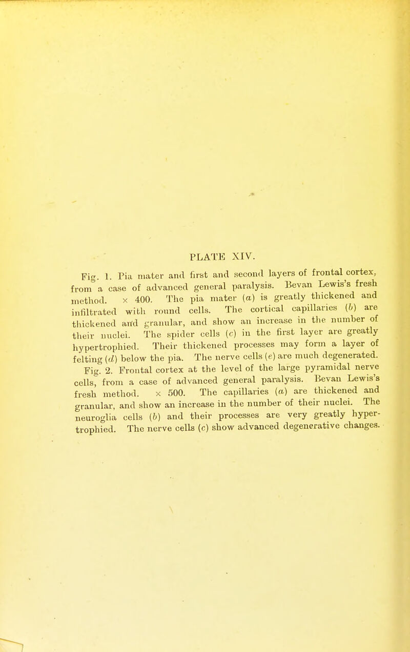 Fig. 1. Piu mater and first and second layers of frontal cortex, from a case of advanced general paralysis. Eevan Lewis's fresh method. x 400. The pia mater (a) is greatly thickened and infiltrated with round cells. The cortical capillaries (6) are thickened arid granular, and show an increase in tlie number of their nuclei. The spider cells (c) in the first layer are greatly hypertrophied. Their thickened processes may form a layer of felting (d) below the pia. The nerve cells (e) are much degenerated. Fig. 2. Frontal cortex at the level of the large pyramidal nerve cells, from a case of advanced general paralysis. Bevau Lewis's fresh method. x 500. The capillaries (a) are thickened and granular, and show an increase in the number of their nuclei. The neuroglia cells (b) and their processes are very greatly hyper- trophied. The nerve cells (c) show advanced degenerative changes. \