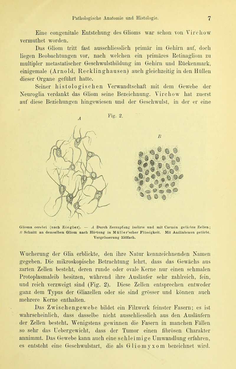 Eine congenitale Entstehung des Glioms war selion von Vircliow vermuthet worden. Das Gliom tritt fast ausschliesslich primär im Gehirn auf, doch liegen Beobachtungen vor, nach welchen ein primäres Eetinagliom zu multipler metastatischer Geschwulstbildung im Gehirn und Eückenmark, einigemale (Arnold, Recklinghausen) auch gleichzeitig in den Hüllen dieser Organe geführt hatte. Seiner histologischen Verwandtschaft mit dem Gewebe der Neuroglia verdankt das Güom seine Bezeichnung. Virchow hat zuerst auf diese Beziehungen hingewiesen und der Geschwulst, in der er eine Glioma cerebri (nach Ziegler), — A Durch Zerzupfang isolirte und mit Carmia gefärbte Zellen; /; Schnitt an demselben Gliom nach Härtung in Müller'scher Flüssigkeit. Mit Anilinbraun gelärbl. Vergrösserung 350fach. Wucherung der Glia erblickte, den ihre Natur kennzeichnenden Namen gegeben. Die mikroskopische Betrachtung lehrt, dass das Gewächs aus zarten Zellen besteht, deren runde oder ovale Kerne nur einen schmalen Protoplasmaleib besitzen, während ihre Ausläufer sehr zahlreich, fein, und reich verzweigt sind (Fig. 2). Diese Zellen entsprechen entweder ganz dem Typus der Gliazellen oder sie sind grösser und können auch mehrere Kerne enthalten. Das Zwischengewebe bildet ein Filzwerk feinster Pasern; es ist wahi'scheinhch, dass dasselbe nicht ausschliesshch aus den Ausläufern der Zellen besteht. Wenigstens gewinnen die Fasern in manchen Fällen so sehr das Uebergewicht, dass der Tumor einen fibrösen Charakter annimmt. Das Gewebe kann auch eine schleimige Umwandlung erfahren, es entsteht eine Geschwulstart, die als G1 i o m}- x o m bezeichnet wird. A Fig. 2.