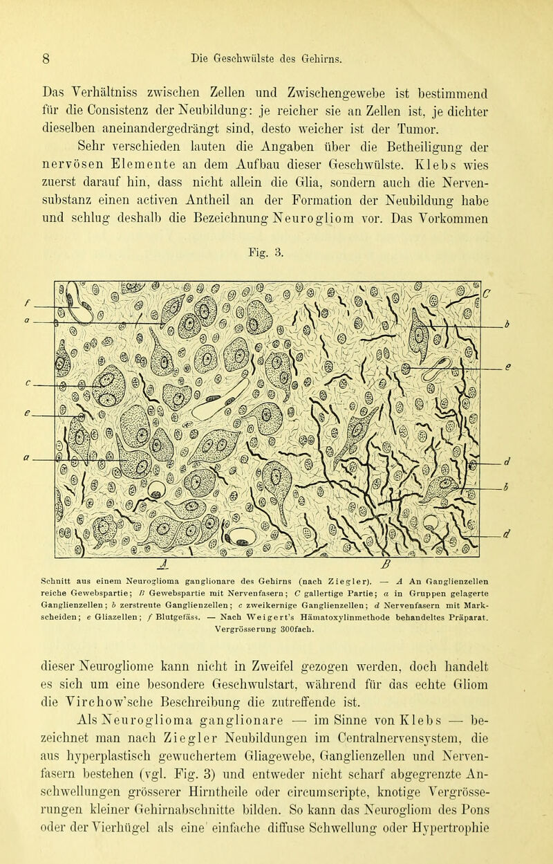 Das Verhältniss zwischen Zellen und Zwischengewebe ist bestimmend für die Consistenz der Neubildung: je reicher sie an Zellen ist, je dichter dieselben aneinandergedrängt sind, desto weicher ist der Tumor. Sehr verschieden lauten die Angaben über die Betheiligung der nervösen Elemente an dem Aufbau dieser Geschwülste. Klebs wies zuerst darauf hin, dass nicht allein die Glia, sondern auch die Nerven- substanz einen activen Antheil an der Formation der Neubildung habe und schlug deshalb die Bezeichnung Neurogliom vor. Das Vorkommen Fig. 3. A B Schnitt aus einem Neuio;Iioma ganglionare des Gehirns (nach Ziegler). — A An Ganglienzellen reiche Gewebspartie; B Gewebspartie mit Nervenfasern; C gallertige Partie; a in Gruppen gelagerte Ganglienzellen; b zerstreute Ganglienzellen; c zweikeinige Ganglienzellen; d Nervenfasern mit Mark- scheiden; eGliazellen; / Blutgefäss. — Nach Weigert's Hämatoxylinmethode behandeltes Präparat. Vergrüsserung 300fach. dieser Neuroghome kann nicht in Zweifel gezogen werden, doch handelt es sich um eine besondere Geschwulstart, während für das echte Gliom die Virchow'sche Besehreibung die zutreffende ist. Als Neuroglioma ganglionare — im Sinne von Klebs — be- zeichnet man nach Ziegler Neubildungen im Centrainervensystem, die aus hyperplastisch gewuchertem Gliagewebe, Ganglienzellen und Nerven- fasern bestehen (vgl. Fig. 3) und entweder nicht scharf abgegrenzte An- schwellungen grösserer Hirntheile oder circurascripte, knotige Vergrösse- rnngen kleiner Gehirnabschnitte bilden. So kann das Neurogliom des Pons oder der Vierhügel als eine'einfoche diffuse Schwellung oder Hypertrophie