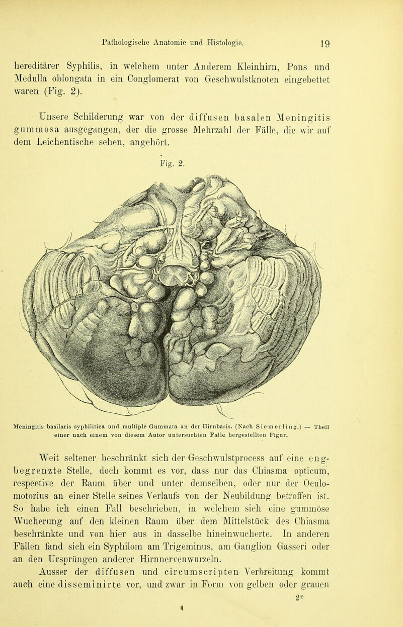 hereditärer Syphilis, in welchem unter Anderem Kleinhirn, Pons und Medulla oblongata in ein Conglomerat von Geschwulstknoten eingebettet waren (Fig. 2). Unsere Schilderung war von der diffusen basalen Meningitis gummosa ausgegangen, der die grosse Mehrzahl der Fälle, die wir auf dem Leichentische sehen, angehört. Fig. 2. Meningitis basilaris syphilitica und multiple Gummala an der Hirnbasis. (Nach Siemerling.) — Theil einer nach einem von diesem Autor untersuchten Falle hergestellten Figur. Weit seltener beschränkt sich der Geschwulstprocess auf eine eng- begrenzte Stelle, doch kommt es vor, dass nur das Chiasma opticum, respective der Eaum über und unter demselben, oder nur der Oculo- motorius an einer Stelle seines Verlaufs von der Neubildung betroffen ist. So habe ich einen Fall beschrieben, in welchem sich eine gummöse Wucherung auf den kleinen Eaum über dem Mittelstück des Chiasma beschränkte und von hier aus in dasselbe hineinwucherte. In anderen Fällen fand sich ein Syphilom am Trigeminus, am Ganglion Gassen oder an den Ursprüngen anderer Hirnnervenwurzeln. Ausser der diffusen und cir cum Scripten Verbreitung kommt auch eine disseminirte vor, und zwar in Form von gelben oder grauen 2* «