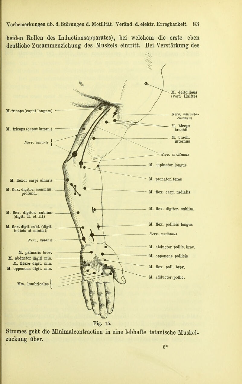 beiden Rollen des Inductionsapparates), bei welchem die erste eben deutliche Zusammenziehung des Muskels eintritt. Bei Verstärkung des M. triceps (Caput longnm) M. triceps (capnt intern.) Nerv, ulnaris | M. flesor carpi ulnaris M. flex. digitor. commun. profund. M. flex. digitor. snbJim. (digiti II et lU) M. flex. digit. subl. (digit. indicis et minimi) Nerv, ulnaris M. palmaris brev. M. abductor digiti min. M. flexor digit. min. M. opponens digit. min. Mm. lumbricales M. flex. pollicis longus Nerv, medianus M. abductor poUic. trev. M. opponens poUicis M. flex. poll. brev. M. adductor pollic. Fig. 15. Stromes geht die Minimalcontraction in eine lebhafte tetanische Muskel- zuckung über. 6*