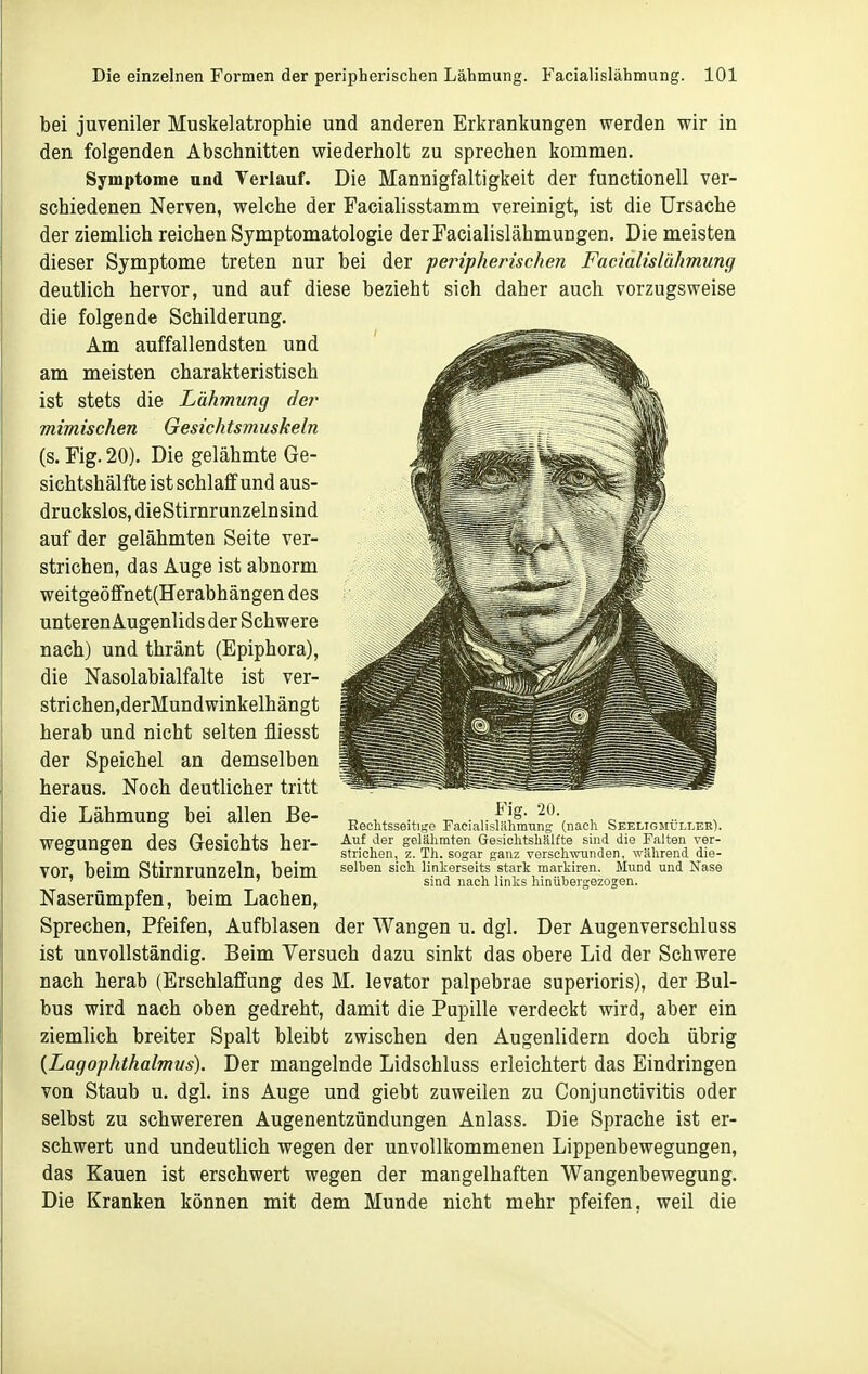bei juveniler Muskelatrophie und anderen Erkrankungen werden wir in den folgenden Abschnitten wiederholt zu sprechen kommen. Symptome und Verlauf. Die Mannigfaltigkeit der functionell ver- schiedenen Nerven, welche der Facialisstamm vereinigt, ist die Ursache der ziemlich reichen Symptomatologie derFacialislähmungen. Die meisten dieser Symptome treten nur bei der peripherischen Facialislähmung deutlich hervor, und auf diese bezieht sich daher auch vorzugsweise die folgende Schilderung. Am auffallendsten und am meisten charakteristisch ist stets die Lähmung der mimischen Gesichtsmuskeln (s. Fig. 20). Die gelähmte Ge- sichtshälfte ist schlaff und aus- druckslos, dieStirnrunzelnsind auf der gelähmten Seite ver- strichen, das Auge ist abnorm weitgeöfFnet(Herabhängen des unteren Augenlids der Schwere nach) und thränt (Epiphora), die Nasolabialfalte ist ver- strichen,derMundwinkelhängt herab und nicht selten fliesst der Speichel an demselben heraus. Noch deutlicher tritt die Lähmung bei allen Be- wegungen des Gesichts her- vor, beim Stirnrunzeln, beim Naserümpfen, beim Lachen, Sprechen, Pfeifen, Aufblasen ist unvollständig. Fig. 20. Rechtsseitige Facialislähmung (nach Seeltgmüller). Auf der gelähmten Gesichtshalfte sind die Palten ver- strichen, z. Th. sogar ganz verschwunden, -sTälirend die- selben sich linkerseits stark markiren. IVIund und Nase sind nach links hinübergezogen. der Wangen u. dgl. Der Augenverschluss Beim Versuch dazu sinkt das obere Lid der Schwere nach herab (Erschlaffung des M. levator palpebrae superioris), der Bul- bus wird nach oben gedreht, damit die Pupille verdeckt wird, aber ein ziemlich breiter Spalt bleibt zwischen den Augenlidern doch übrig {Lagophthalmus). Der mangelnde Lidschluss erleichtert das Eindringen von Staub u. dgl. ins Auge und giebt zuweilen zu Conjunctivitis oder selbst zu schwereren Augenentzündungen Anlass. Die Sprache ist er- schwert und undeutlich wegen der unvollkommenen Lippenbewegungen, das Kauen ist erschwert wegen der mangelhaften Wangenbewegung. Die Kranken können mit dem Munde nicht mehr pfeifen, weil die