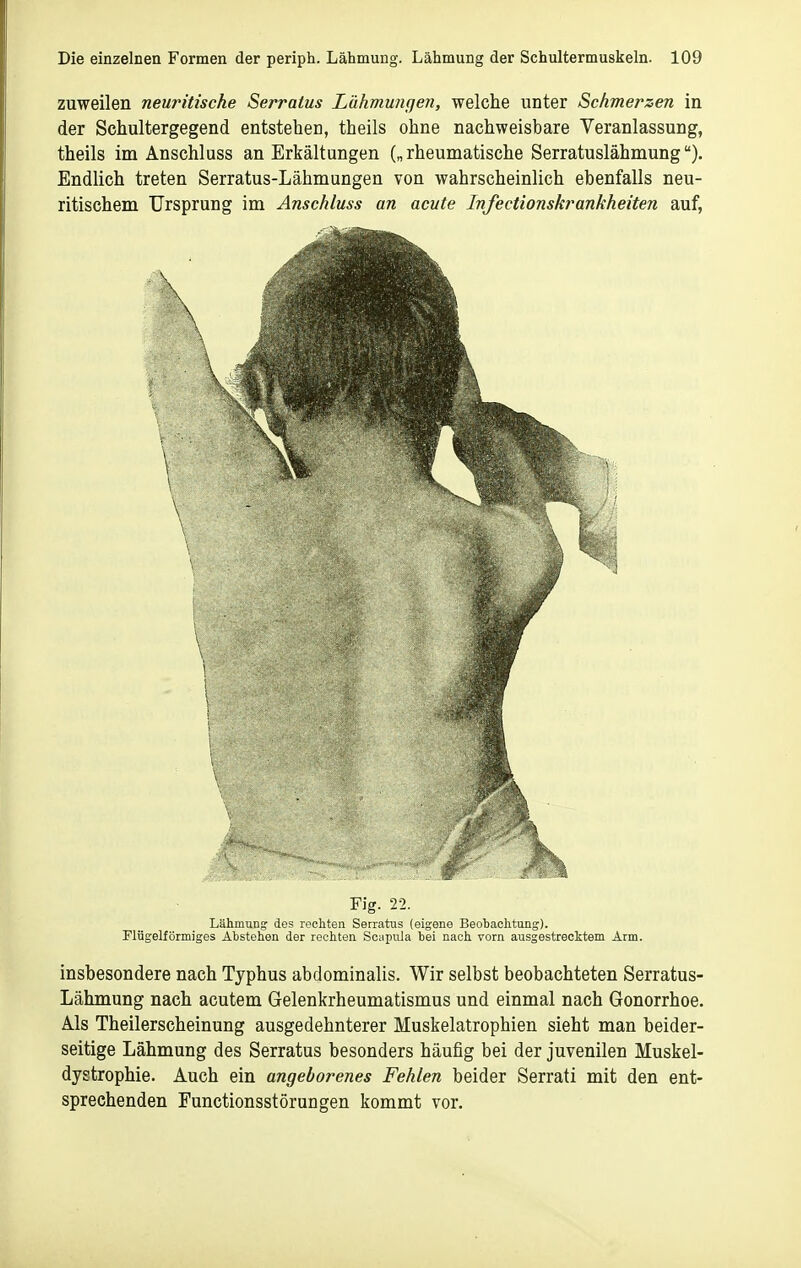 zuweilen neuritische Serratus Lähmungen, welche unter Schmerzen in der Schultergegend entstehen, theils ohne nachweisbare Veranlassung, theils im Anschluss an Erkältungen („ rheumatische Serratuslähmung). Endlich treten Serratus-Lähmungen von wahrscheinlich ebenfalls neu- ritischem Ursprung im Anschluss an acute Infectionskrankheiten auf, Fig. 22. Lähmung des rechten Serratus (eigene Beobachtung), riügelförmiges Abstehen der rechten Scapnla bei nach vorn ausgestrecktem Arm. insbesondere nach Typhus abdominalis. Wir selbst beobachteten Serratus- Lähmung nach acutem Gelenkrheumatismus und einmal nach Gonorrhoe. Als Theilerscheinung ausgedehnterer Muskelatrophien sieht man beider- seitige Lähmung des Serratus besonders häufig bei der juvenilen Muskel- dystrophie. Auch ein angeborenes Fehlen beider Serrati mit den ent- sprechenden Functionsstörungen kommt vor.