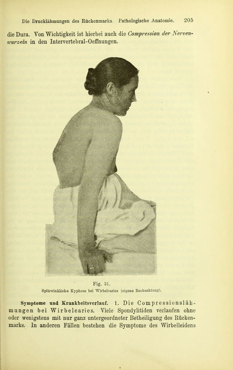 die Dura. Von Wichtigkeit ist hierbei auch die Compression der Nerven- wurzeln in den Intervertehral-Oeffnungen. Fig. 31. SpitrwinMiche Kyphose bei Wirbelcaries (eigene Beobachtung). Symptome und KranklieitsTerlauf. 1. Die Compressionsläh- mungen bei Wirbelcaries. Viele Spondyütiden verlaufen ohne oder wenigstens mit nur ganz untergeordneter Betheiligung des Rücken- marks. In anderen Fällen bestehen die Symptome des Wirbelleidens