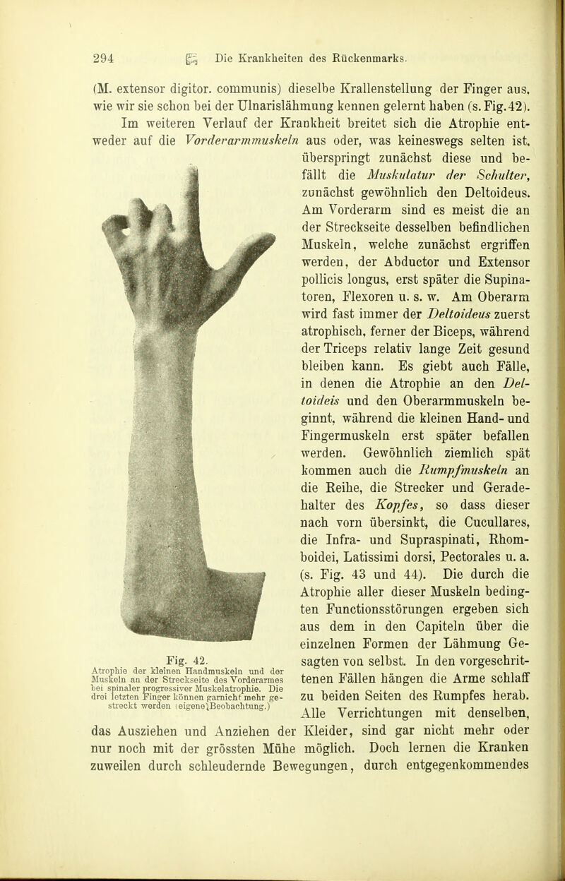 (M. extensor digitor. communis) dieselbe Krallenstellung der Finger aus. wie wir sie schon bei der Ulnarislähmung kennen gelernt haben (s.Fig.42). Im weiteren Verlauf der Krankheit breitet sich die Atrophie ent- weder auf die Vorderarmmuskeln aus oder, was keineswegs selten ist. überspringt zunächst diese und be- fällt die Muskulatur der Schulter, zunächst gewöhnlich den Deltoideus. Am Vorderarm sind es meist die an der Streckseite desselben befindlichen Muskeln, welche zunächst ergriffen werden, der Abductor und Extensor pollicis longus, erst später die Supina- toren, Flexoren u. s. w. Am Oberarm wird fast immer der Deltoideus zuerst atrophisch, ferner der Biceps, während derTriceps relativ lange Zeit gesund bleiben kann. Es giebt auch Fälle, in denen die Atrophie an den Del- toideis und den Oberarmmuskeln be- ginnt, während die kleinen Hand- und Fingermuskeln erst später befallen werden. Gewöhnlich ziemlich spät kommen auch die Rumpfmuskeln an die Reihe, die Strecker und Gerade- halter des Kopfes, so dass dieser nach vorn übersinkt, die CucuUares, die Infra- und Supraspinati, Rhom- boidei, Latissimi dorsi, Pectorales u. a. (s. Fig. 43 und 44). Die durch die Atrophie aller dieser Muskeln beding- ten Functionsstörungen ergeben sich aus dem in den Capiteln über die einzelnen Formen der Lähmung Ge- sagten von selbst. In den vorgeschrit- tenen Fällen hängen die Arme schlaff zu beiden Seiten des Rumpfes herab. Alle Verrichtungen mit denselben, das Ausziehen und Anziehen der Kleider, sind gar nicht mehr oder nur noch mit der grössten Mühe möglich. Doch lernen die Kranken zuweilen durch schleudernde Bewegungen, durch entgegenkommendes Fig. 42. Atrophie der kleinen Handmuskeln und der Muskeln an der Streckseite des Vorderarmes Ijei spinaler progrressivGr Muskelatiophie. Die drei letzten Finger können {rarnichf mehr ge- streckt werden leigene'iBeohaclitung.)