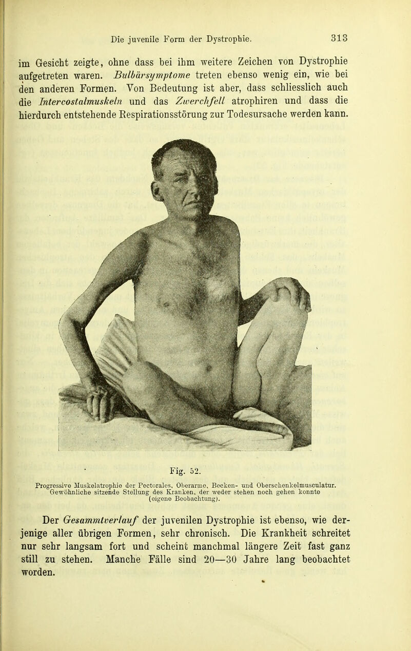 im Gesicht zeigte, ohne dass bei ihm weitere Zeichen von Dystrophie aufgetreten waren. Bitlbärsymptome treten ebenso wenig ein, wie bei den anderen Formen. Von Bedeutung ist aber, dass schliesslich auch die Intercostalmuskeln und das Zwerchfell atrophiren und dass die hierdurch entstehende Respirationsstörung zur Todesursache werden kann. Fig. 52. Progressive Mustelatrophie der Pectorales, Oberarmo, Becken- und Obersclienkelmusculatur. Gewöhnliche sitzende Stellung des Kranken, der weder stehen noch gehen konnte (eigene BeobachtungJ. Der Gesammtverlavf der juvenilen Dystrophie ist ebenso, wie der- jenige aller übrigen Formen, sehr chronisch. Die Krankheit schreitet nur sehr langsam fort und scheint manchmal längere Zeit fast ganz still zu stehen. Manche Fälle sind 20—30 Jahre lang beobachtet worden.