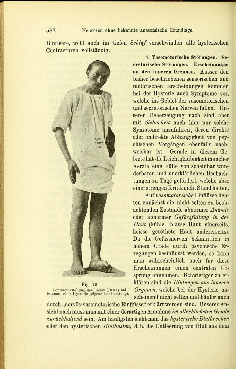 Blutleere, wohl auch im tiefen Schlaf verschwinden alle hysterischen Contracturen vollständig. 4. Vasomotorische Störungen. Se- cretorische Störungen. Erscheinungen an den inneren Organen. Ausser den bisher beschriebenen sensorischen und motorischen Erscheinungen kommen bei der Hysterie auch Symptome vor, welche ins Gebiet der vasomotorischen und secretorischen Nerven fallen. Un- serer TJeberzeugung nach sind aber mit Sicherheit auch hier nur solche Symptome anzuführen, deren direkte oder indirekte Abhängigkeit von psy- chischen Vorgängen ebenfalls nach- weisbar ist. Gerade in diesem Ge- biete hat die Leichtgläubigkeit mancher Aerzte eine Fülle von scheinbar wun- derbaren und unerklärlichen Beobach- tungen zu Tage gefördert, welche aber einer strengen Kritik nicht Stand halten. Auf vasomotorische Einflüsse deu- ten zunächst die nicht selten zu beob- achtenden Zustände abnormer Anämie oder abnormer Gefässßillung in der Haut (kühle, blasse Haut einerseits, heisse geröthete Haut andererseits). Da die Gefässnerven bekanntlich in hohem Grade durch psychische Er- regungen beeinflusst werden, so kann man wahrscheinlich auch für diese Erscheinungen einen centralen Ur- sprung annehmen. Schwieriger zu er- klären sind die Blutungen aus inneren Organen, welche bei der Hysterie an- scheinend nicht selten und häufig auch durch „nervös-vasomotorische Einflüsse erklärt worden sind. Unserer An- sicht nach muss man mit einer derartigen Annahme im allerhöchsten Grade zurückhaltend sein. Am häufigsten sieht man das hysterische Blutbrechen oder den hysterischen Bluthusten, d. h. die Entleerung von Blut aus dem Fig. 76. ContractursfeUung des linken Fusses bei träumatischer Hysterie (eigene Beobachtong).