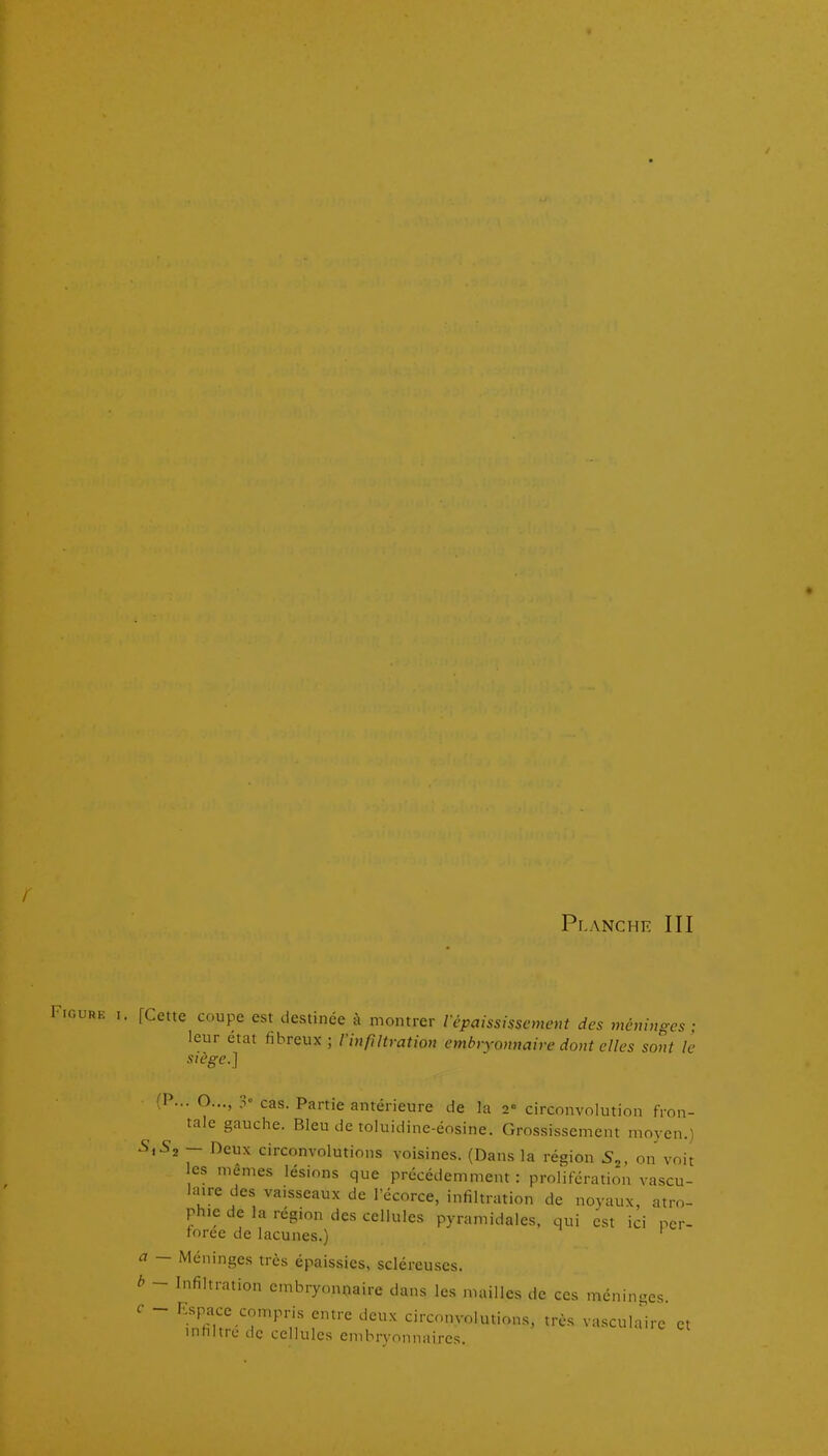 Figure i. [Cette coupe est destinée à montrer répaississcmc-m des méninges ■ leur état fibreux ; rinpHration embryonnaire dont elles sont le siège.] (P... O..., > cas. Partie antérieure de la 2° circonvolution fron- tale gauche. Bleu de toluidine-éosine. Grossissement moyen.) 5,52 - Deux circonvolutions voisines. (Dans la région S^, on voit es mêmes lésions que précédemment : prolifération vascu- laire des vaisseaux de Técorce, infiltration de noyaux, atro- phie de la région des cellules pyramidales, qui est ici per- forée de lacunes.) ' a — Méninges très épaissies, sclércuses. à ~ Infiltration embryonnaire dans les mailles de ces méninges c ~ Espace compris entre deux circonvolutions, très vasculn'irc et mfiltre de cellules embryonnaires.