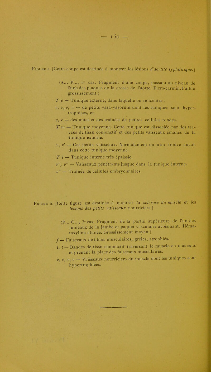 — I 3o — 1 FiGURF. I. [Cette coupe est destinée à montrer les lésions d'aortite syphilitique.] (A... P..., 1° cas. Fragment d'une coupe, passant au niveau de l'une des plaques de la crosse de l'aorte. Picro-carmin. Faible grossissement.) Te — Tunique externe, dans laquelle on rencontre : V, V, V, V — de petits vasa-vasorum dont les tuniques sont hyper- trophiées, et c, c — des amas et des traînées de petites cellules rondes. T m — Tunique moyenne. Cette tunique est dissociée par des tra- vées de tissu conjonctif et des petits vaisseaux émanes de la tunique externe. 1'' — Ces petits vaisseaux. Normalement on nen trouve aucun dans cette tunique moyenne. T i — Tunique interne très épaissie. v, v — Vaisseaux pénétrants jusque dans la tunique interne, c — Traînée de cellules embryonnaires. FioURB 2. [Cette ligure est destinée à montrer la sclérose du muscle et les lésions des petits vaisseaux nourriciers.] (P... O..., 3° cas. Fragment delà partie supérieure de l'un des jumeaux de la jambe et paquet vasculaire avoisinant. Héma- toxyline alunée. Grossissement moyen.) / — Faisceaux de fibres musculaires, grêles, atrophiés. t, t — Bandes de tissu conjonctif traversant le muscle en tous sens et prenant la place des faisceaux musculaires. „^ V — Vaisseaux nourriciers du muscle dont les tuniques sont hypertrophiées.