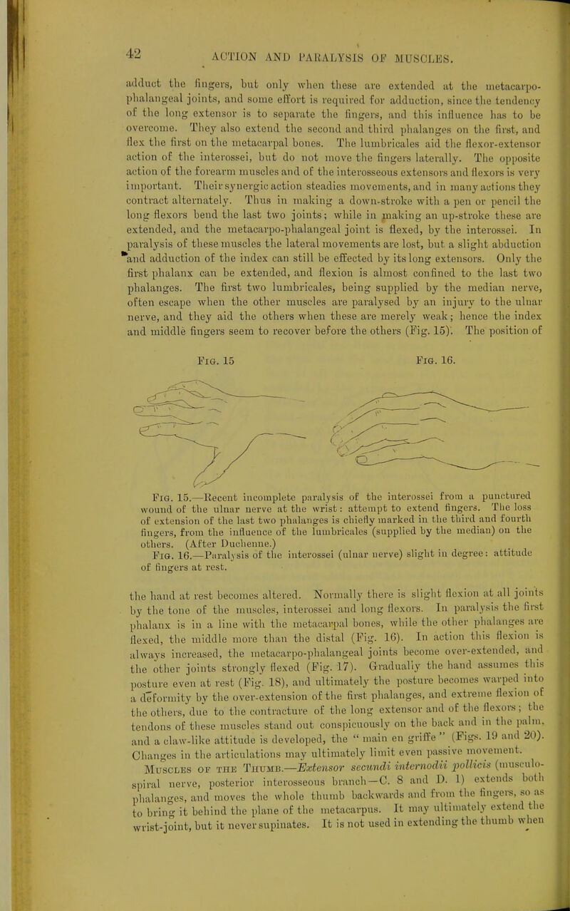 adduot the lingers, but only when these are extended at the metacarpo- phalangeal joints, and sonic effort is required for adduction, since the tendency of the long extensor is to separate the fingers, and this influence lias to be overcome. The)' also extend the second and third phalanges on the first, and flex the first on the metacarpal bones. The lumbricales aid the flexor-extensor action of the interossei, hut do not move the lingers laterally. The opposite action of the forearm muscles and of the interosseous extensors and flexors is very important. Their synergic action steadies movements, and in many actions they contract alternately. Thus in making a down-stroke with a pen or pencil the long flexors bend the last two joints; while in making an up-stroke these are extended, and the metacarpophalangeal joint is flexed, by the interossei. In paralysis of these muscles the lateral movements are lost, but. a slight abduction *and adduction of the index can still be effected by its long extensors. Only the first phalanx can be extended, and flexion is almost confined to the last two phalanges. The first two lumbricales, being supplied by the median nerve, often escape when the other muscles are paralysed by an injury to the ulnar nerve, and they aid the others when these are merely weak; hence the index and middle fingers seem to recover before the others (Fig. 15). The position of Fig. 15 Fig. 16. Fig. 15.—Itecent incomplete paralysis of the interossei from a punctured wound of the ulnar nerve at the wrist: attempt to extend fingers. The loss of extension of the last two phalanges is chiefly marked in the third aud fourth fingers, from the influence of the lumbricales (supplied by the median) on the others. (After Duchenne.) Fig. 16.—Paralysis of the interossei (ulnar nerve) slight in degree: attitude of fingers at rest. the hand at rest becomes altered. Normally there is slight flexion at all joints by the tone of the muscles, interossei ami long flexors. In paralysis the first phalanx is in a line with the metacarpal bones, while the other phalanges are Hexed, the middle more than the distal (Fig. 16). In action this flexion is always increased, the metacarpophalangeal joints become over-extended, and the other joints strongly flexed (Fig. 17). Gradually the hand assumes this posture even at rest (Fig. 18), and ultimately the posture becomes warped into a deformity by the over-extension of the first phalanges, and extreme flexion of the others, due to the contracture of the long extensor and of the flexors; the tendons of these muscles stand out conspicuously on the hark and in the palm, and a claw-like attitude is developed, the  main en griffe  (Rgs. 19 and 20). Changes in the articulations may ultimately limit even passive movement. Muscles of the Thumb— Extensor secundi intemodii pollicis (musculo- spiral nerve, posterior interosseous branch-C. 8 and D. 1) extends both phalanges, and moves the whole thumb backwards and from tin- fingers, so as to bring it behind the plane of the metacarpus. It may ultimately extend the wrist-joint, but it never supinates. It is not used in extending the thumb when