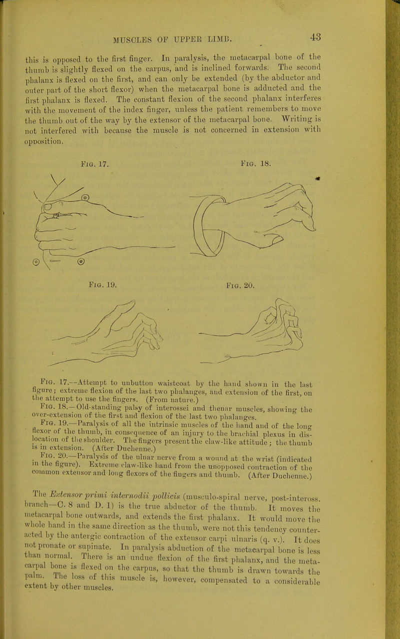 this is opposed to the first finger. In paralysis, the metacarpal hone of the thumb is slightly flexed on the carpus, and is inclined forwards. The second phalanx is flexed on the first, and can only be extended (by the abductor and outer part of the short flexor) when the metacarpal bone is adducted and the first phalanx is flexed. The constant flexion of the second phalanx interferes with the movement of the index finger, unless the patient remembers to move the thumb out of the way by the extensor of the metacarpal bone. Writing is not interfered with because the muscle is not concerned in extension with opuosition. Fig. 17. Fig. 18. Fig. 19. Fig. 20. Fig. 17.—Attempt to unbutton waistcoat by the hand shown in the last figure; extreme flexion of the last two phalanges, and extension of the first, on the attempt to use the fingers. (From nature.) Fig. 18.—Old-standing palsy of iuterossci and thenar muscles, showing the over-extension of the first and flexion of the last two phalanges. Fig. 19.— Paralysis of all the intrinsic muscles of the hand and of the long flexor of the thumb, in consequence of an injury to the brachial plexus in dis- locat.on of the shoulder. The fingers present the claw-like attitude : the thumb is m extension. (Alter Duchenne.) ■ m10' ,Pilralysis of the ulnar nerve r'101» a wound at the wrist (indicated m the figure). Extreme claw-like hand from the unopposed contraction of the common extensor and long flexors of the fingers and thumb. (After Duchenne.) The Extensorprimi internodii joollicis (musoulo-spiral nerve, post-inteross branch—0. 8 and D. 1) is the true abductor of the thumb. It moves the metacarpal bone outwards, and extends the first phalanx. It would move the whole hand in the same direction as the thumb, were not this tendency counter- acted by the antergic contraction of the extensor carpi ulnaris (q. v.) It does not pronate or supinate. In paralysis abduction of the metacarpal bone is less than normal. There is an undue flexion of the first phalanx, and the meta- carpal bone is Hexed on the carpus, so that the thumb is drawn towards the palm ihe. loss of tins muscle is, however, compensated to a considerable extent by other muscles.