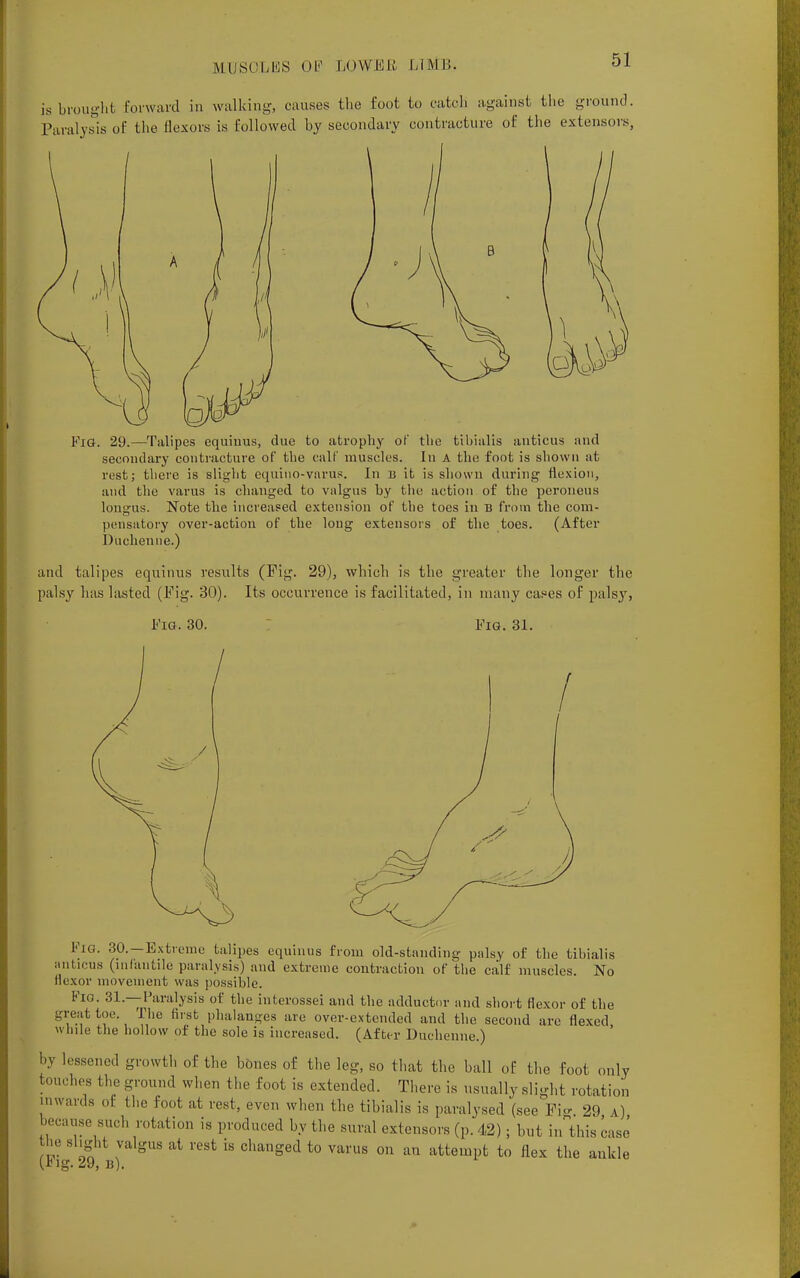 is brought forward in walking, causes the foot to catch against the ground. Paralysis of the flexors is followed by secondary contracture of the extensors, l Fig. 29.—Talipes equiuus, due to atrophy of the tibialis anticus and secondary contracture of the calf muscles. In A the foot is shown at rest; there is slight equino-vnrus. In b it is shown during flexion, and the varus is changed to valgus by the action of the peroneus longus. Note the increased extension of the toes in B from the com- pensatory over-action of the long extensors of the toes. (After Duchenne.) and talipes equinus results (Fig. 29), which is the greater the longer the palsy has lasted (Fig- 30). Its occurrence is facilitated, in many canes of palsy, Fig. 30. Fig. 31. PlG. 30.—Extreme talipes equinus from old-standing palsy of the tibialis anticus (infantile paralysis) and extreme contraction of the calf muscles. No flexor movement was possible. Fio. 31.—Paralysis of the interossei and the adductor and short flexor of the great toe. The first phalanges are over-extended and the second arc flexed while the hollow of the sole is increased. (After Duchenne.) by lessened growth of the bones of the leg, so that the ball of the foot only touches the ground when the foot is extended. There is usually slight rotation inwards of the foot at rest, even when the tibialis is paralysed (see Fig 29 a) because such rotation is produced by the sural extensors (p. 42); but in this case the slight valgus at rest is changed to varus on an attempt to flex the ankle (Fig. 29, b).